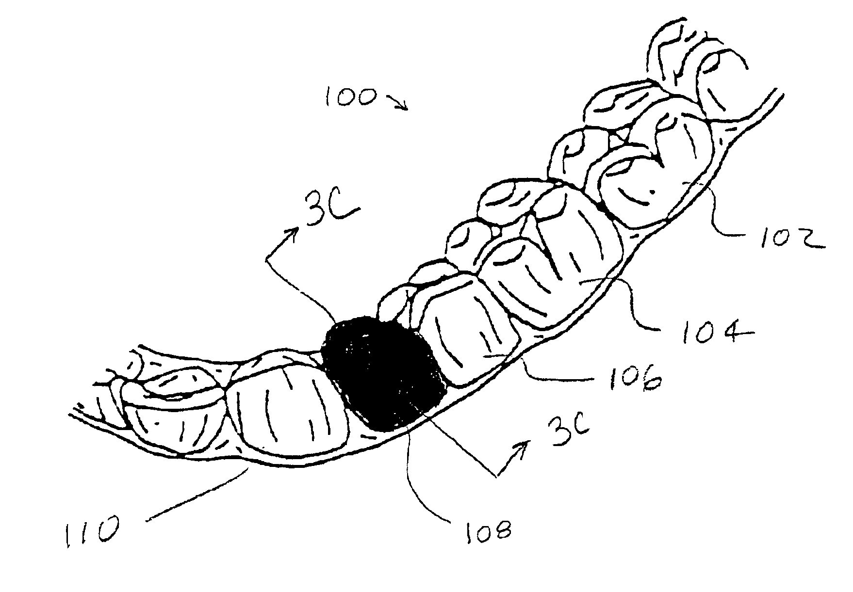 Method and kits for forming pontics in polymeric shell aligners