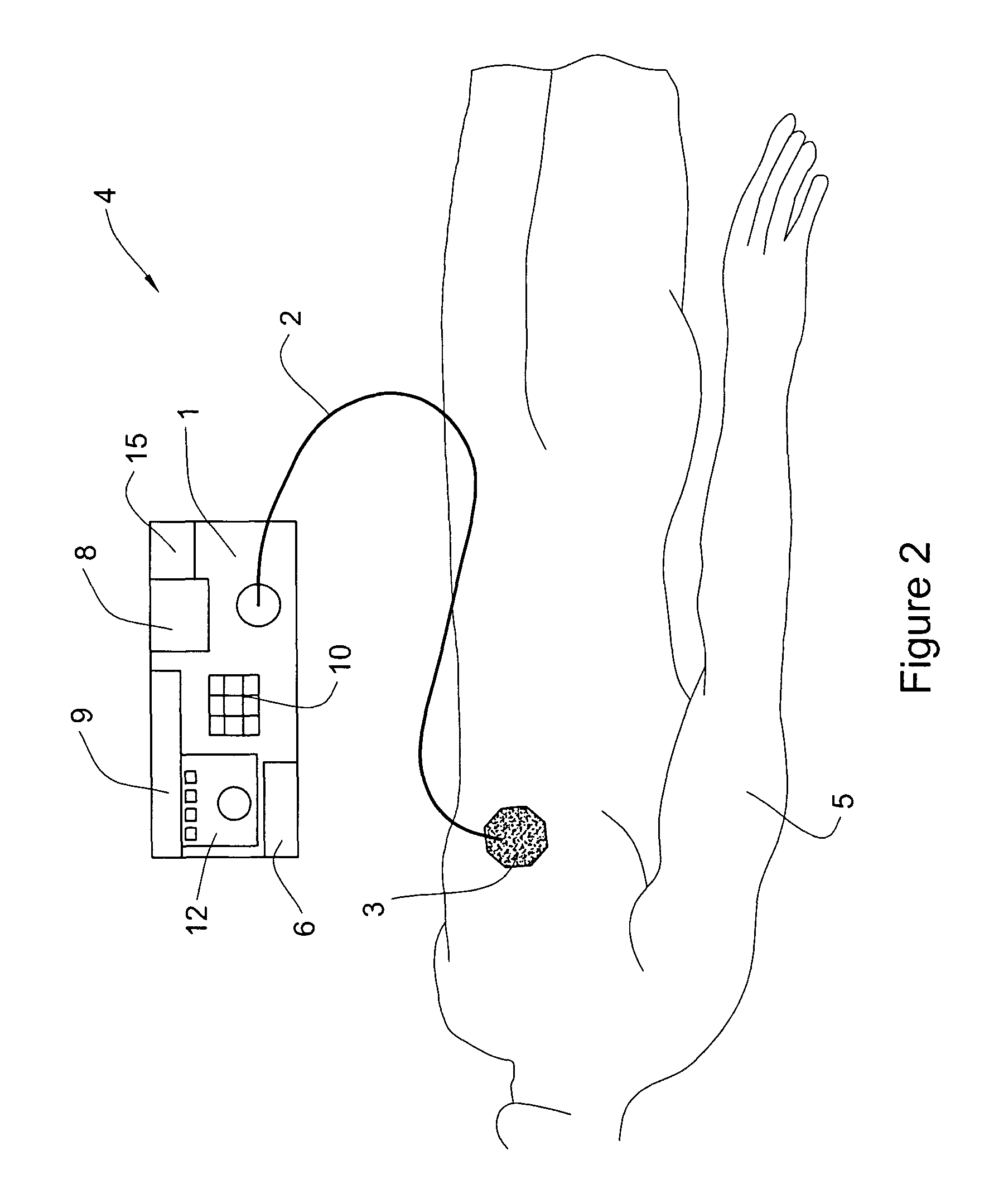 Method and apparatus for treatment of adipose tissue