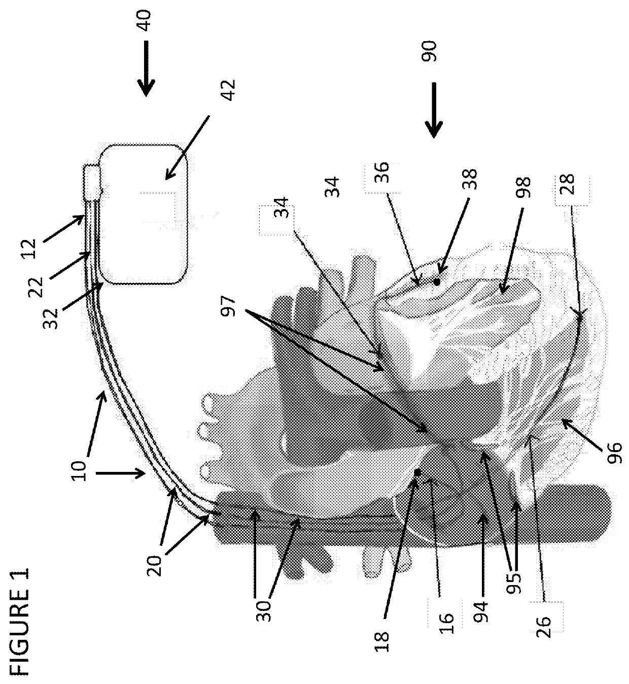 Systems and methods to optimize Anti-tachycardial pacing (ATP)