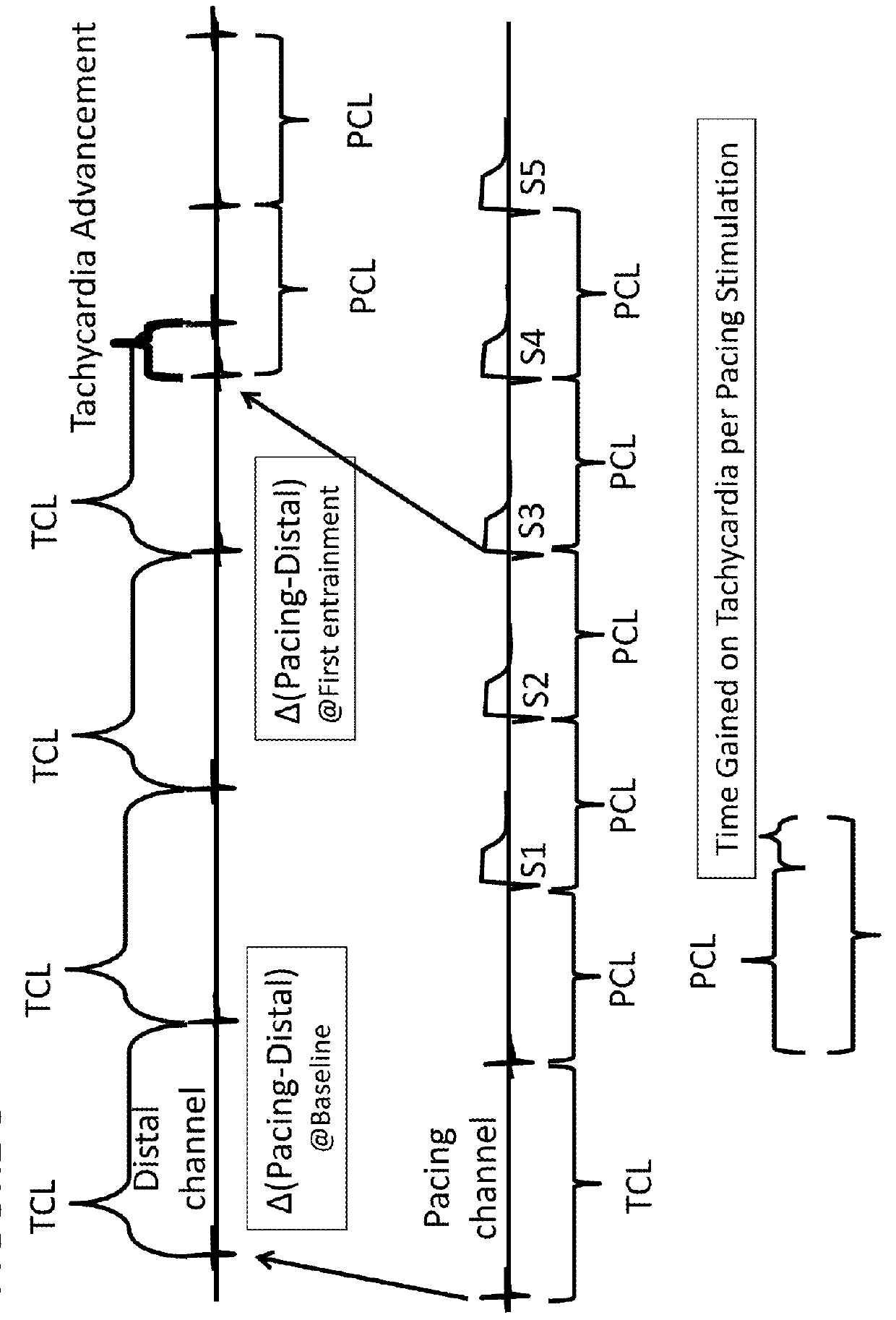 Systems and methods to optimize Anti-tachycardial pacing (ATP)