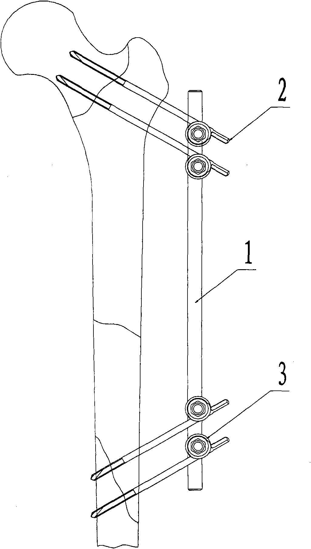 External fixation bracket with pressurized thread for orthopedics