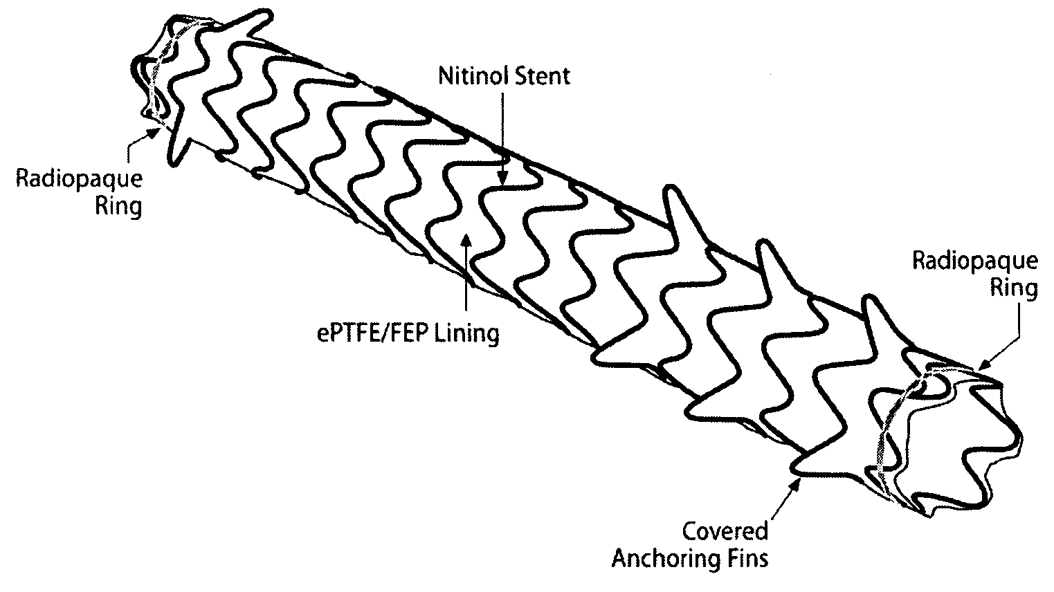 Removeable stents