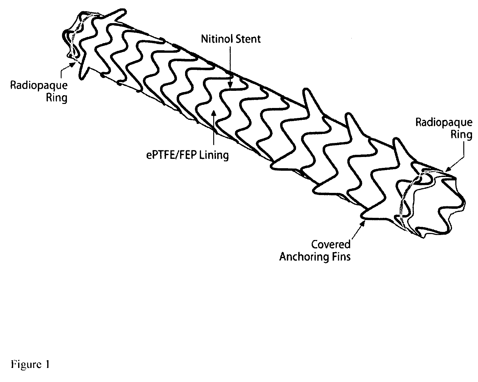 Removeable stents