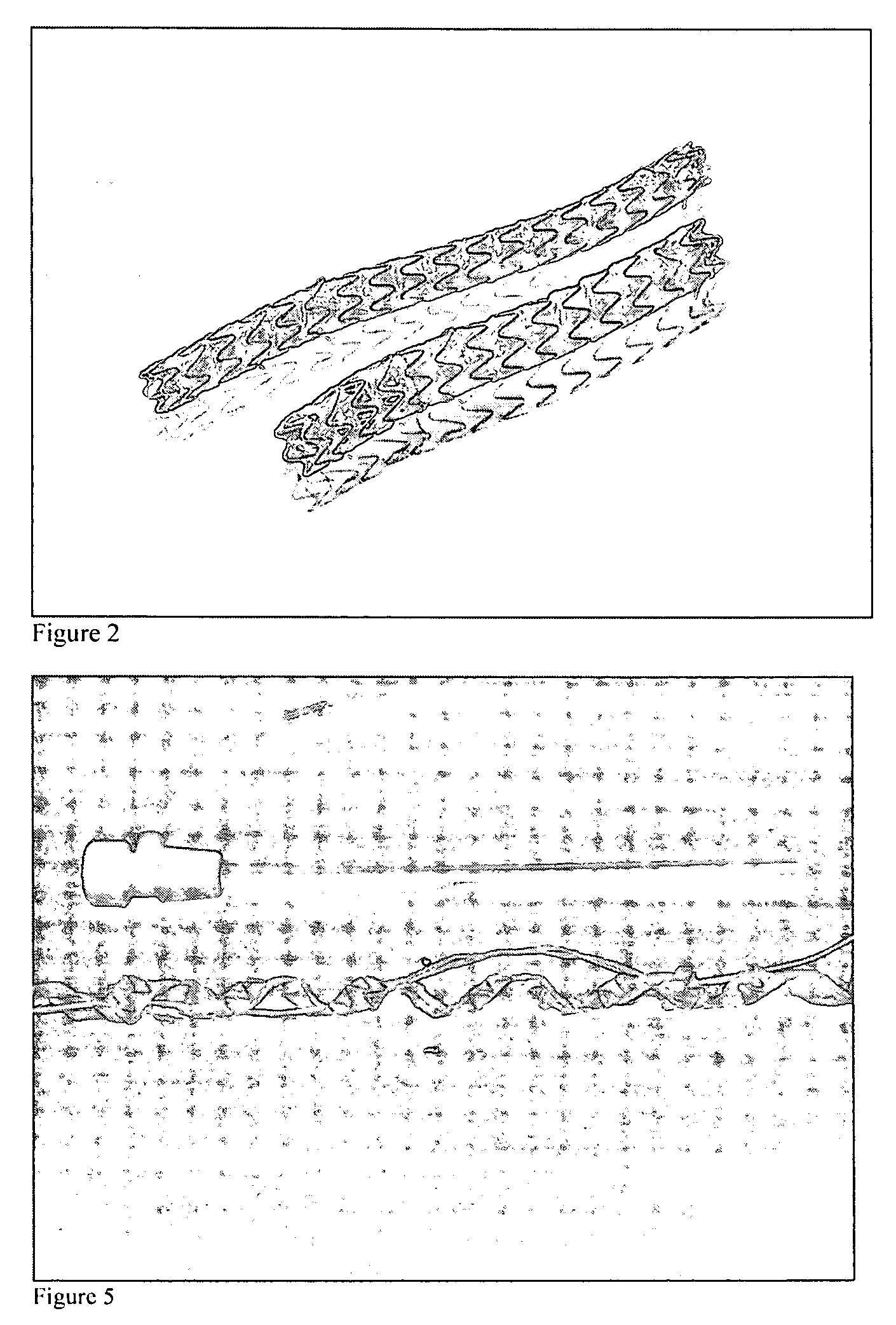 Removeable stents