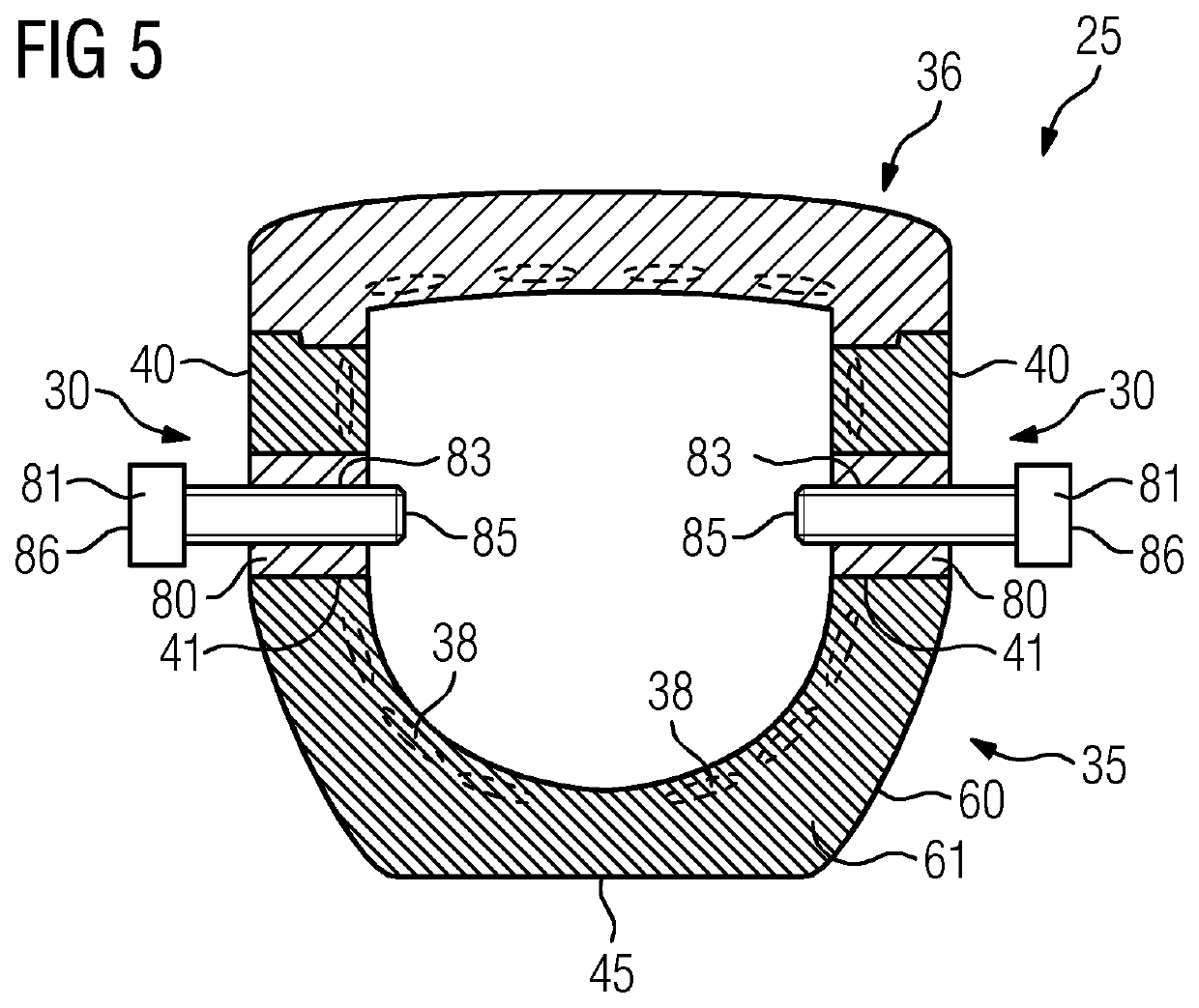 Local coil arrangement for use in an intervention supported by magnetic resonance imaging