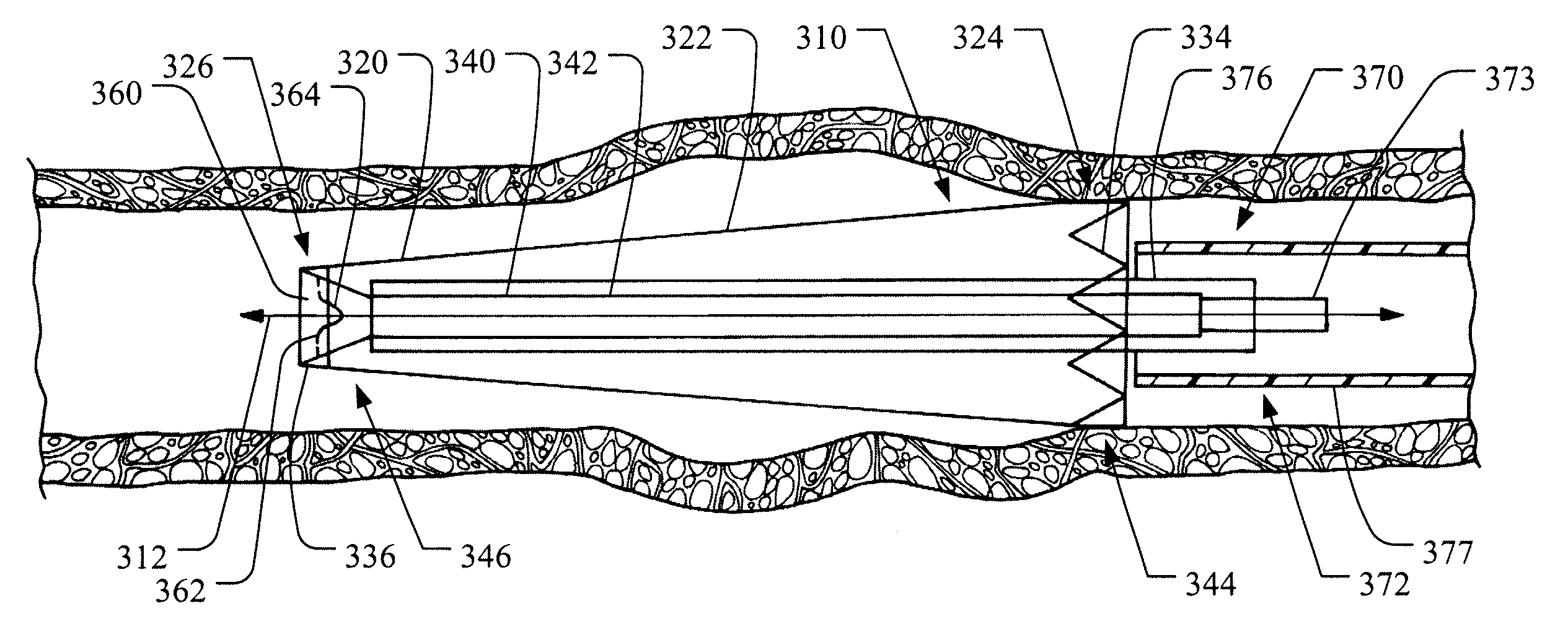 Stent Graft Delivery System for Accurate Deployment