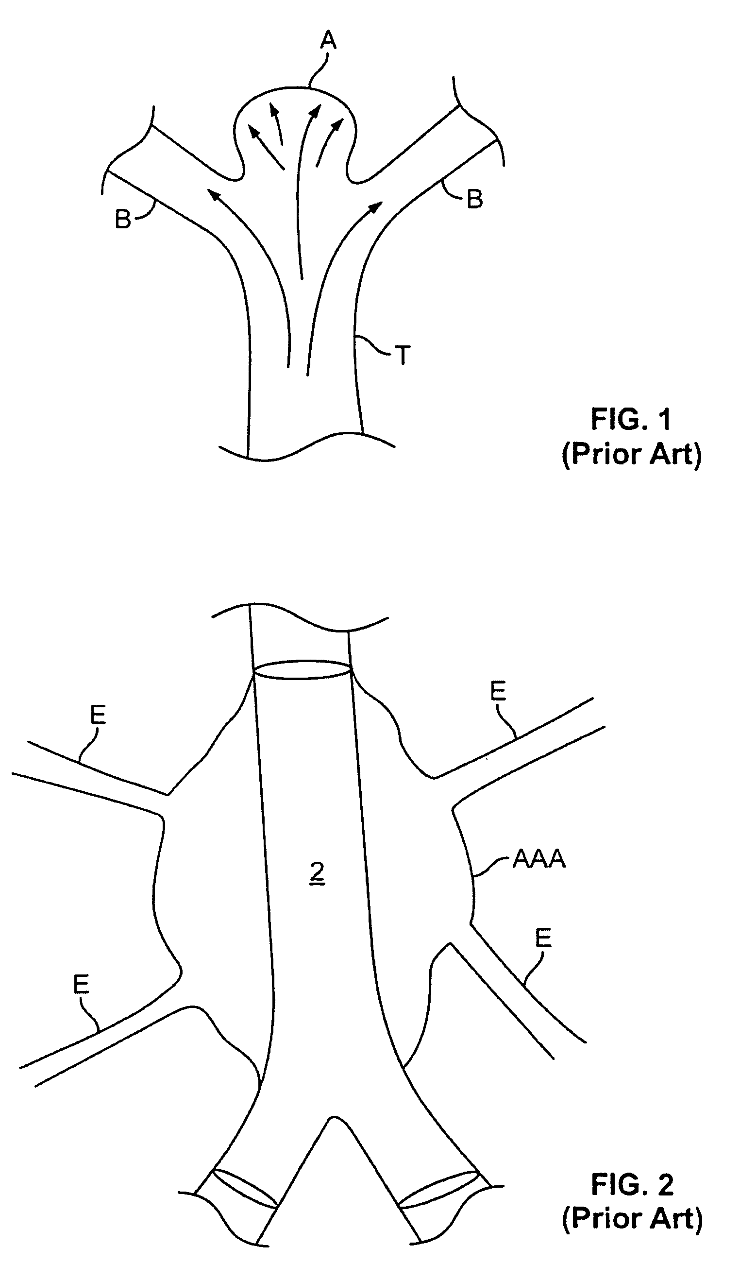 Isolation devices for the treatment of aneurysms