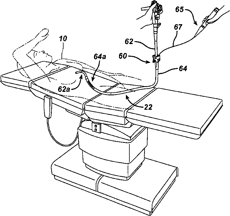 Methods and devices for performing gastrectomies and gastroplasties