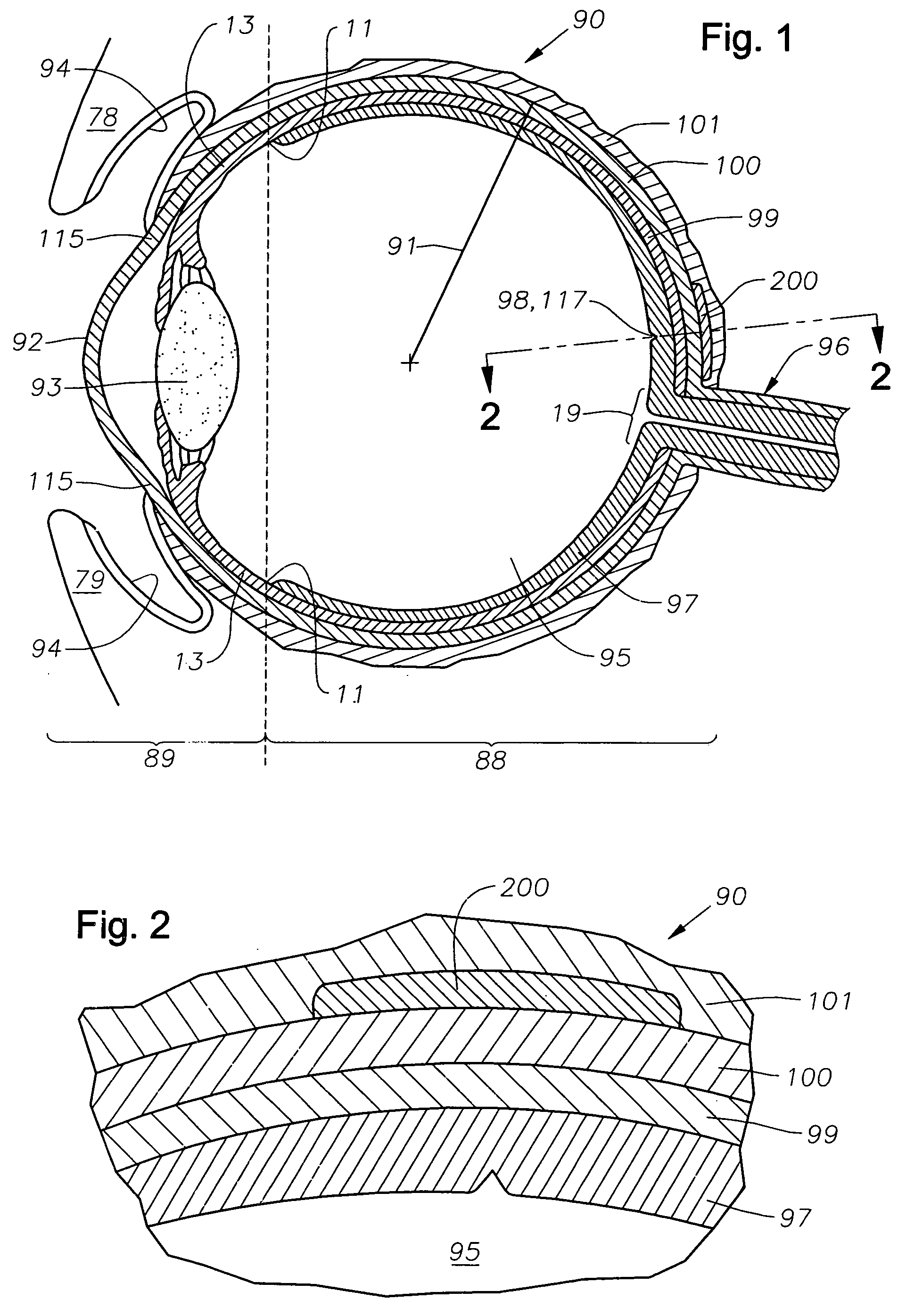 Ophthalmic drug delivery device