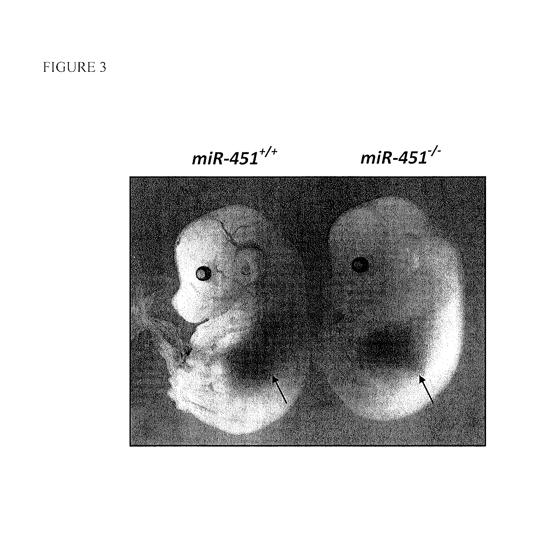 Antimir-451 for the treatment of polycythemias