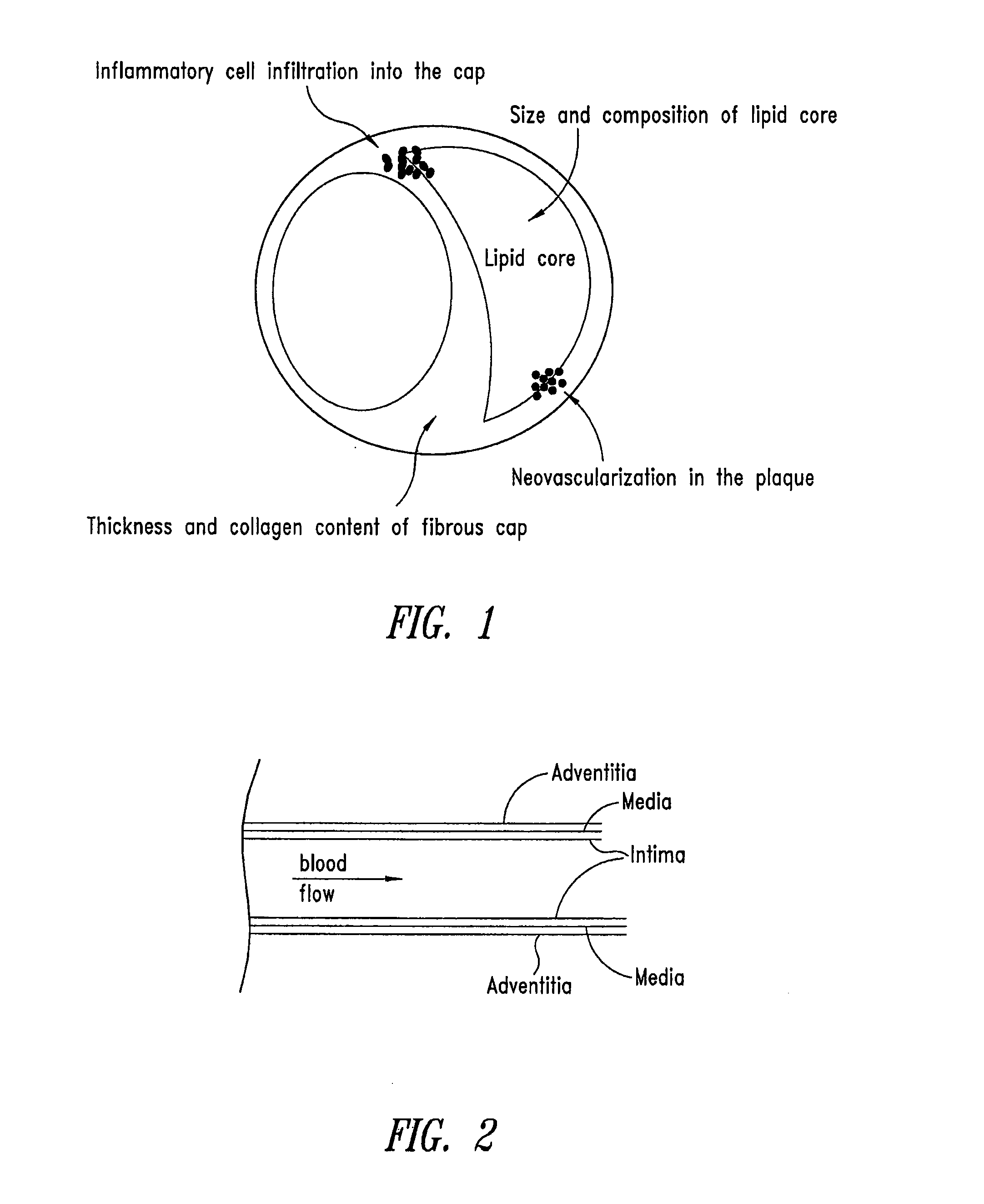 Photoreactive system and methods for prophylactic treatment of atherosclerosis