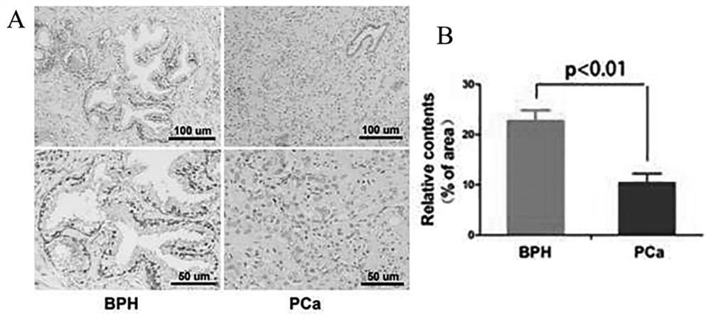 Application of chitosan nanoscale ultrasound contrast agent combined with dickkopf-2 gene in the preparation of drugs for the treatment of prostate cancer