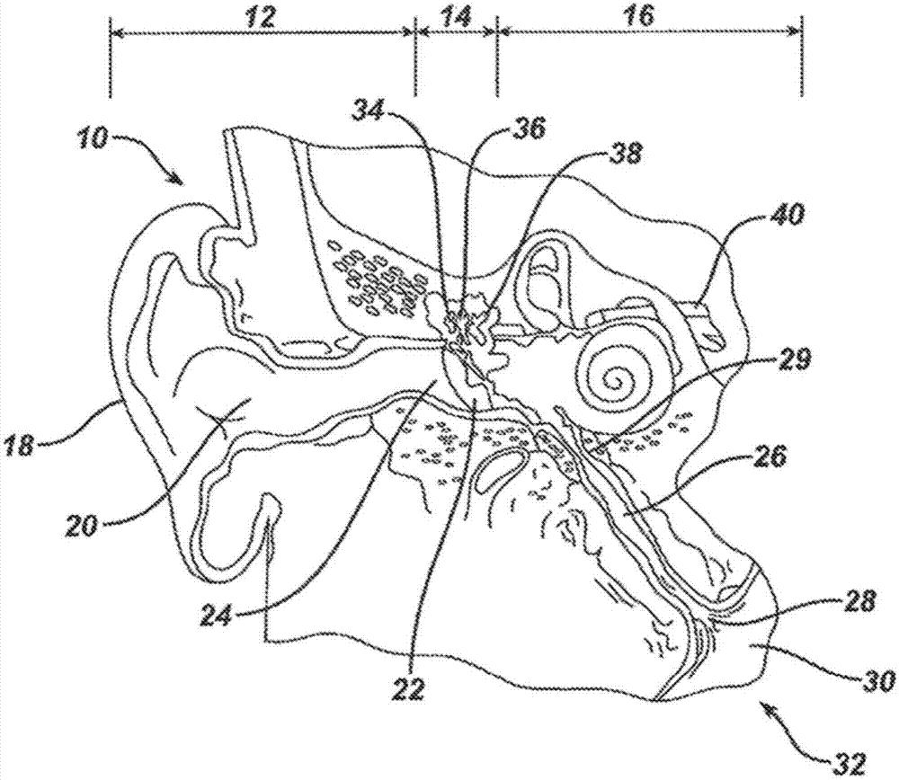 Low profile eustachian tube dilation system