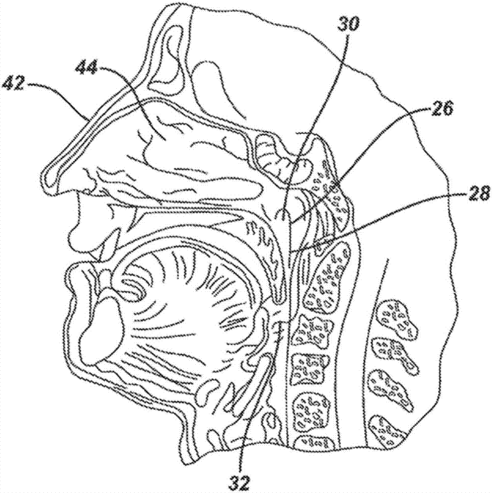 Low profile eustachian tube dilation system