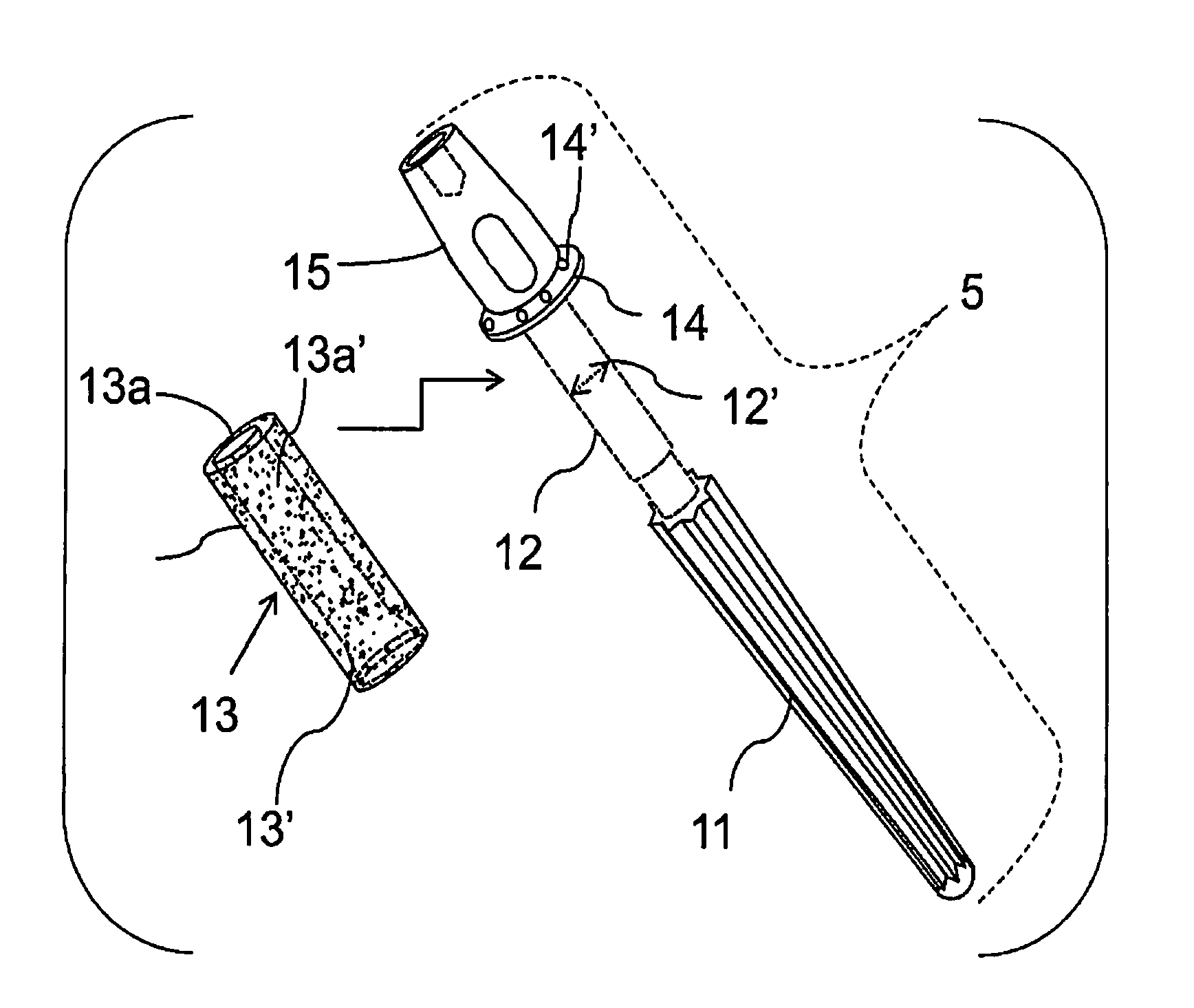 Percutaneous implant for limb salvage