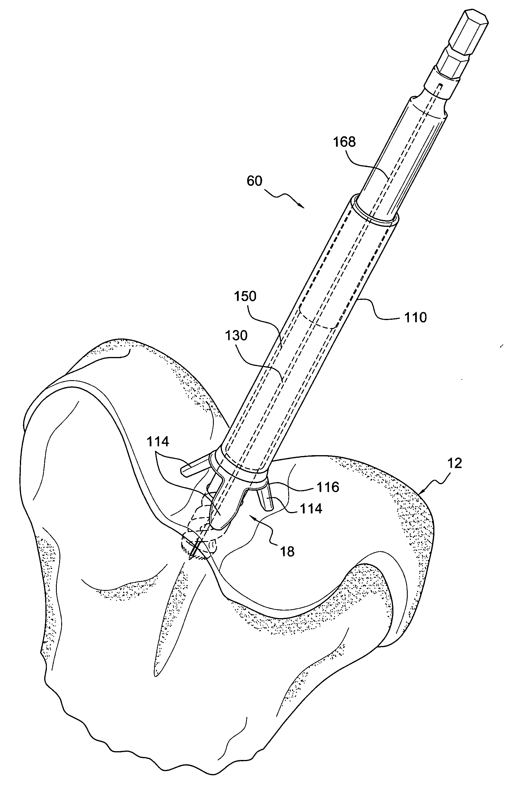 Osteochondral plug graft harvesting instrument, kit and method