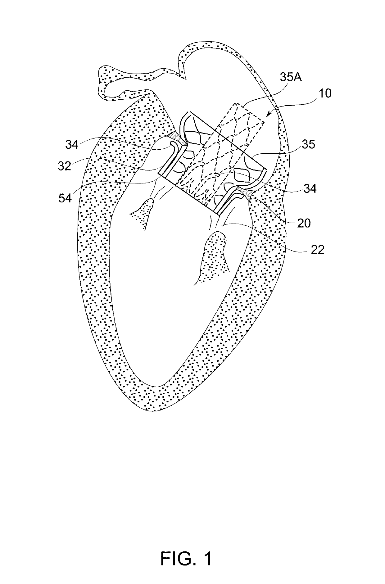 Prosthetic mitral valve