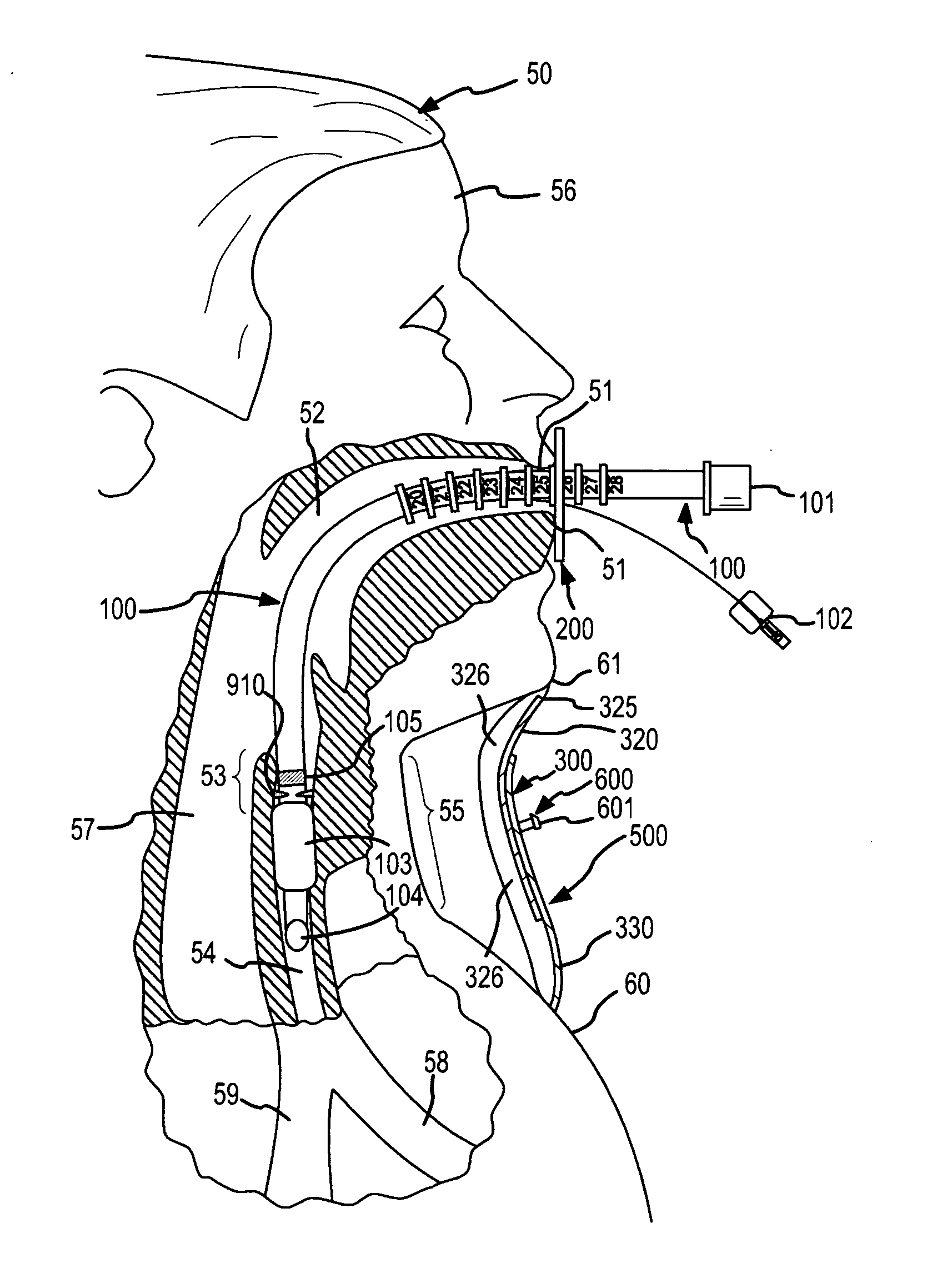 Complete airway stabilization system and method