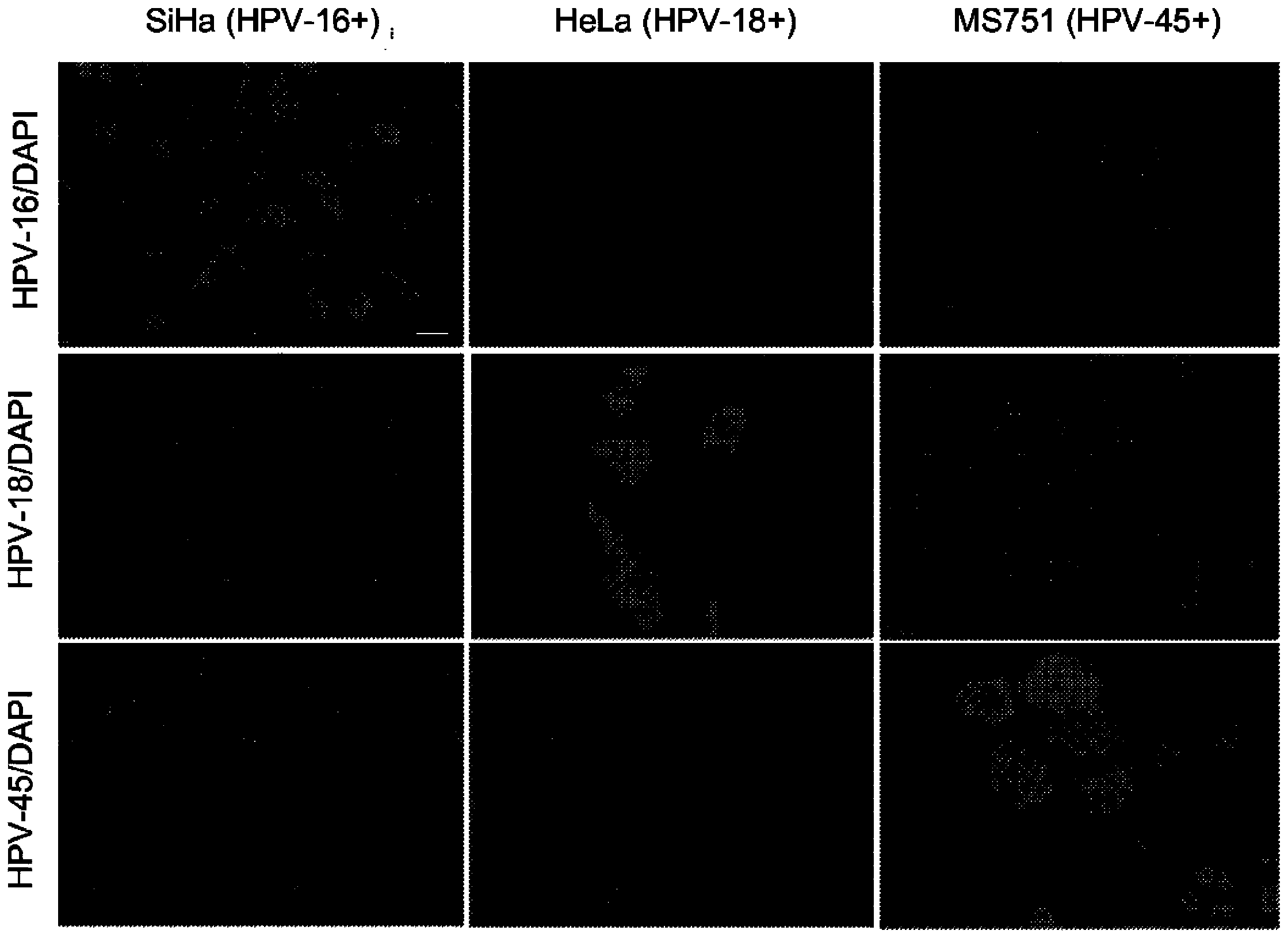 RNAscop (TM) HPV assay for determining HPV status in head and neck cancers and cervical lesions