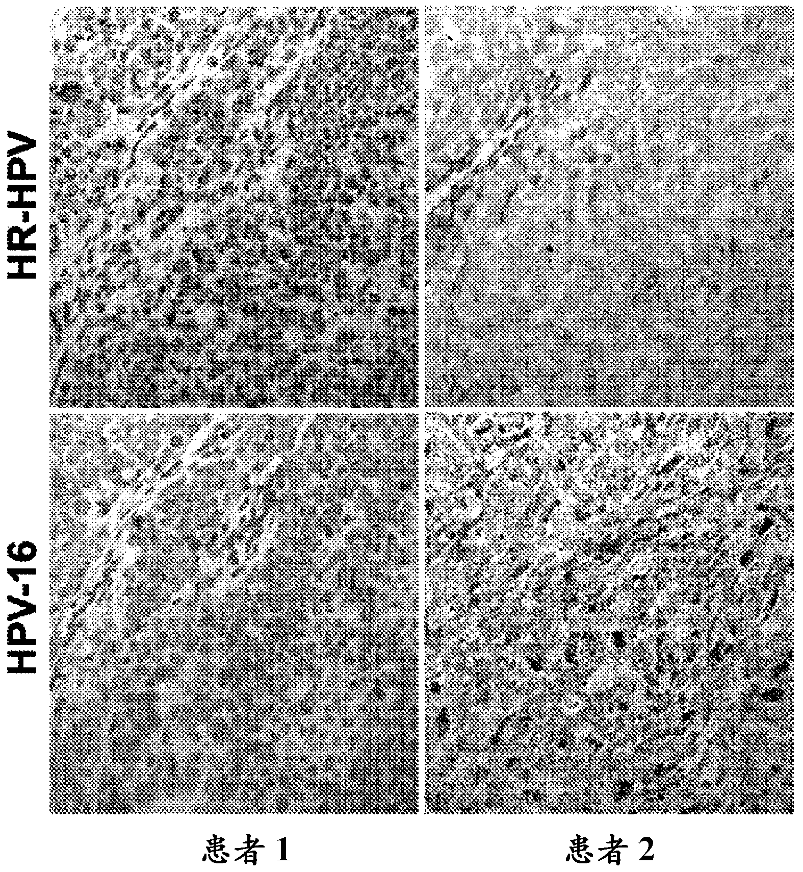 RNAscop (TM) HPV assay for determining HPV status in head and neck cancers and cervical lesions