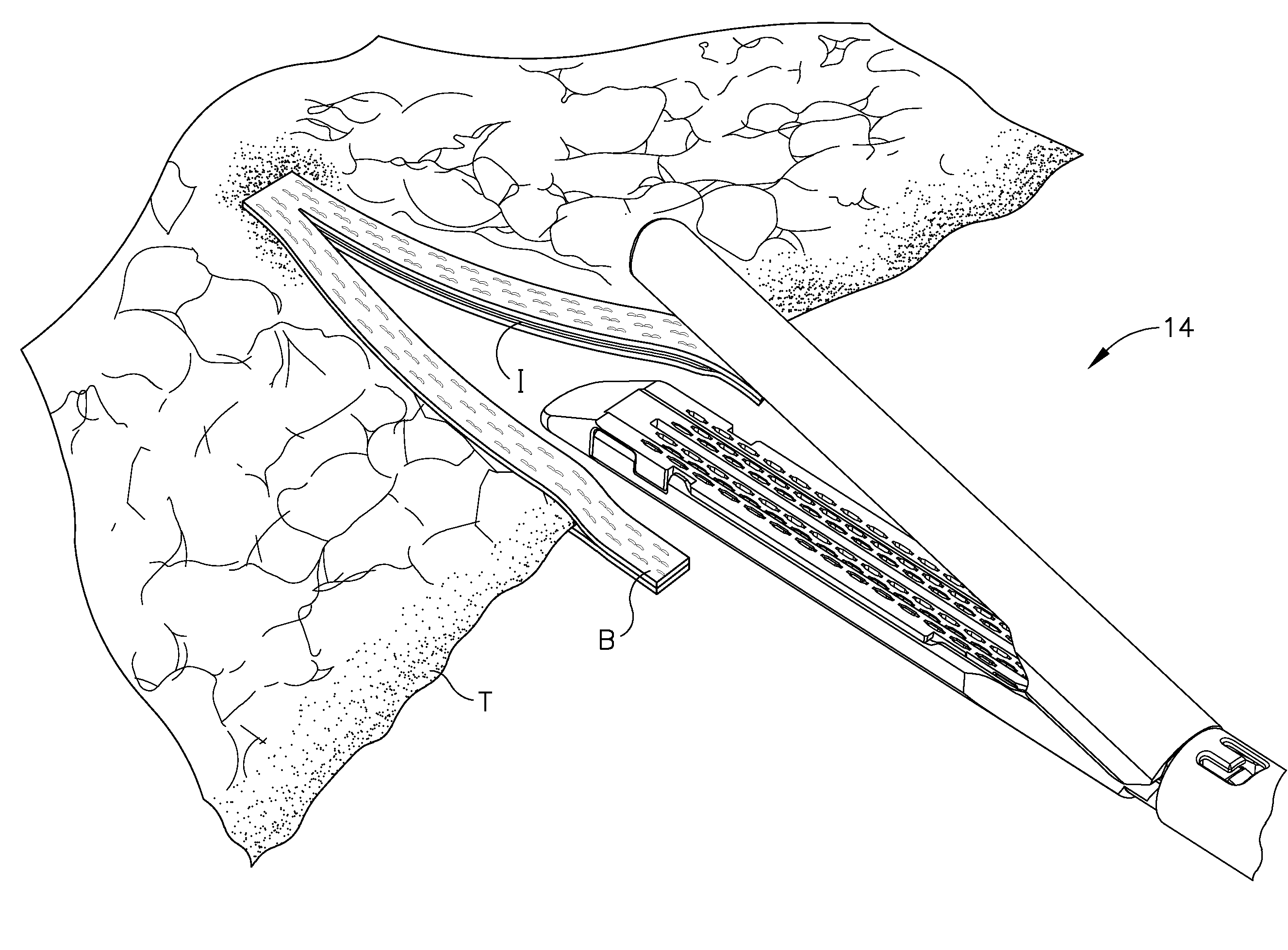 Surgical end effector having buttress retention features