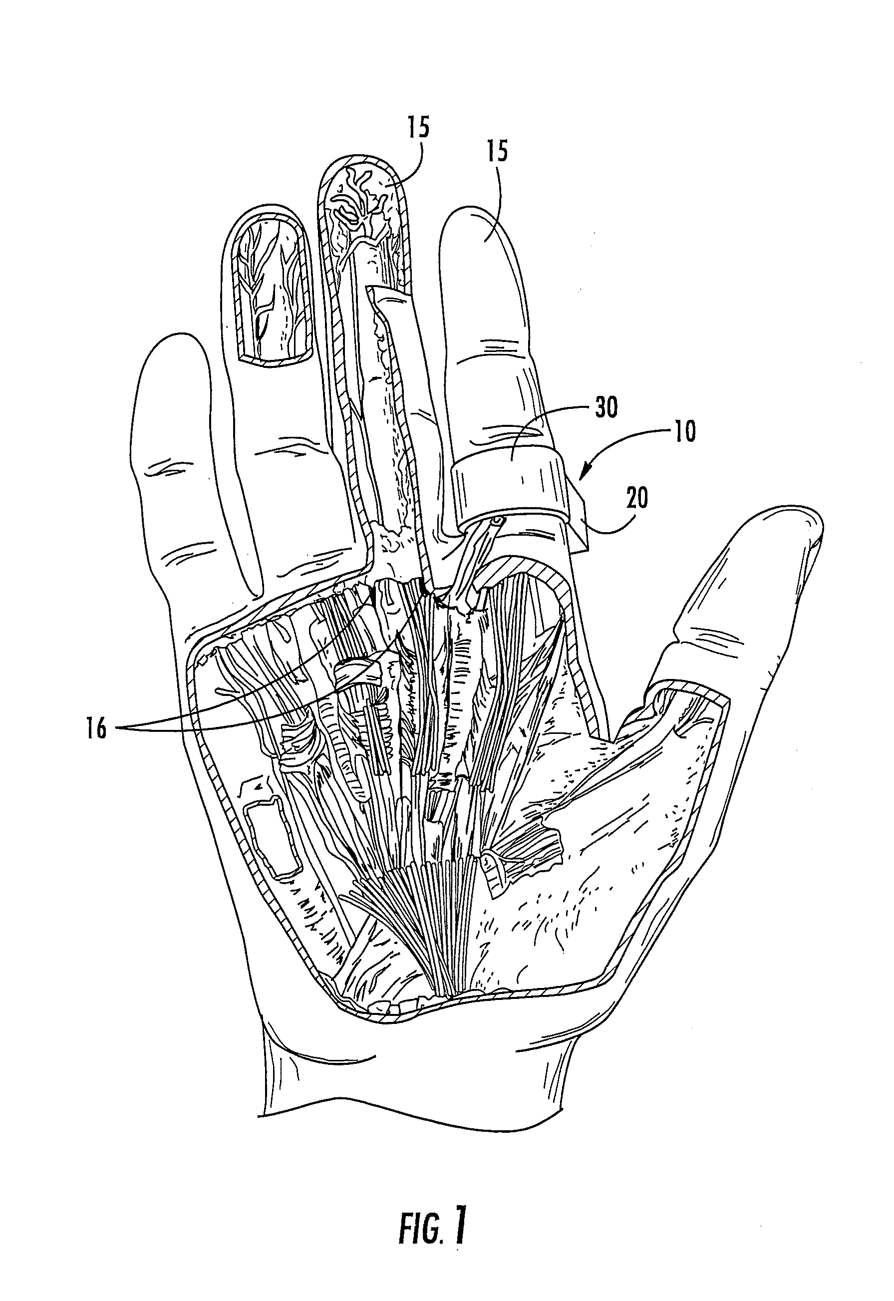 Disposable digital tourniquets and related methods of providing occlusion pressures to a single digit during surgical procedures