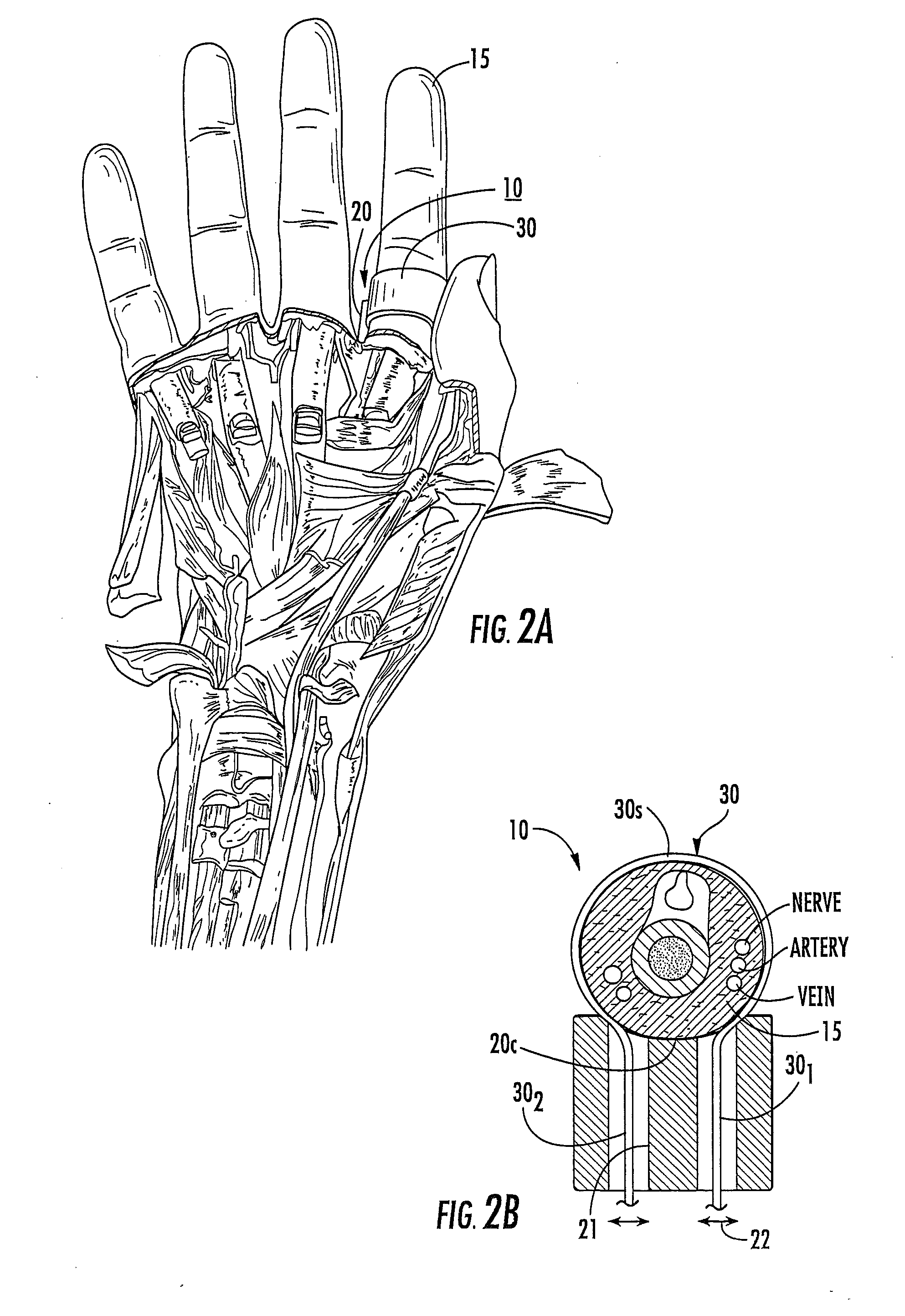 Disposable digital tourniquets and related methods of providing occlusion pressures to a single digit during surgical procedures