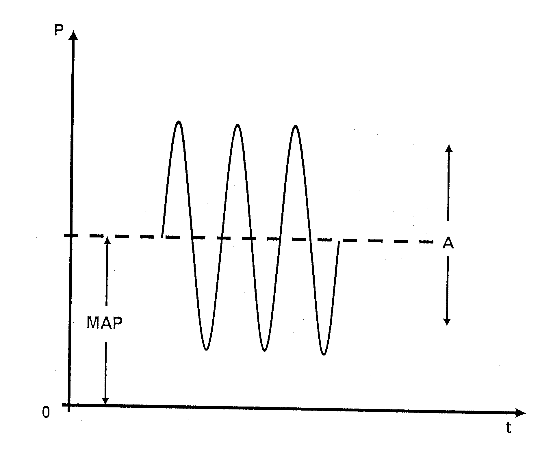 Device and method for respirating a patient by means of high-frequency ventilation