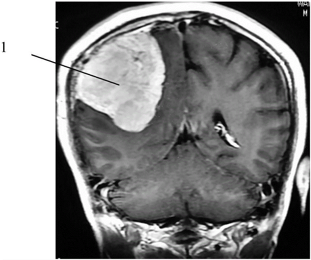 Integral resection method of huge and super huge meningioma