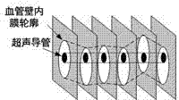 Vascular four-dimensional reconstruction method in NOT gate-controlled ICUS (intravascular ultrasound) image sequence