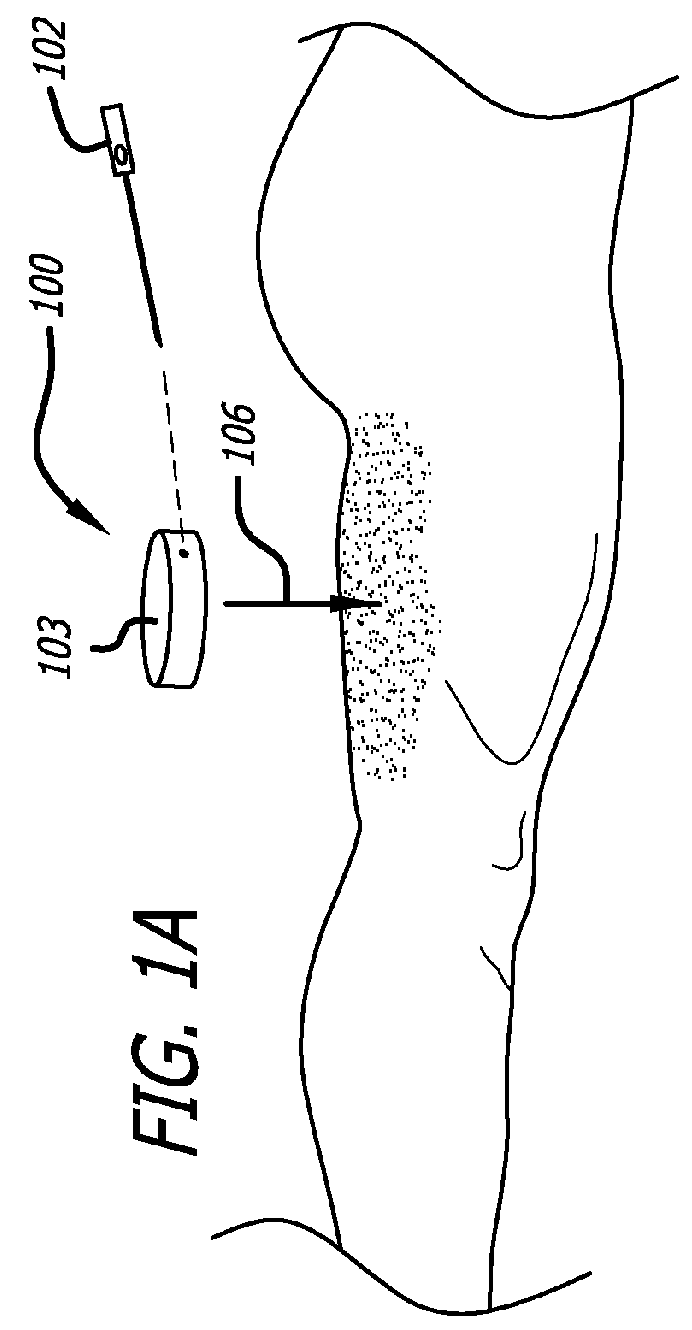 Handpiece and methods for performing subcutaneous surgery