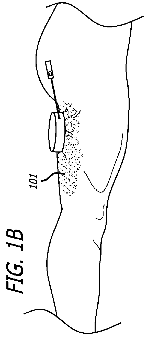 Handpiece and methods for performing subcutaneous surgery