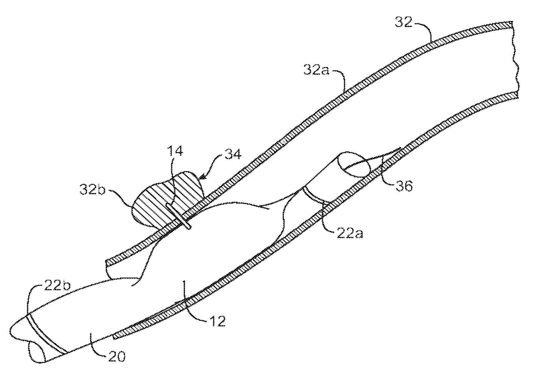 Maintenance of Bronchial Patency by Local Delivery of Cytotoxic, Cytostatic, or Anti-Neoplastic Agent