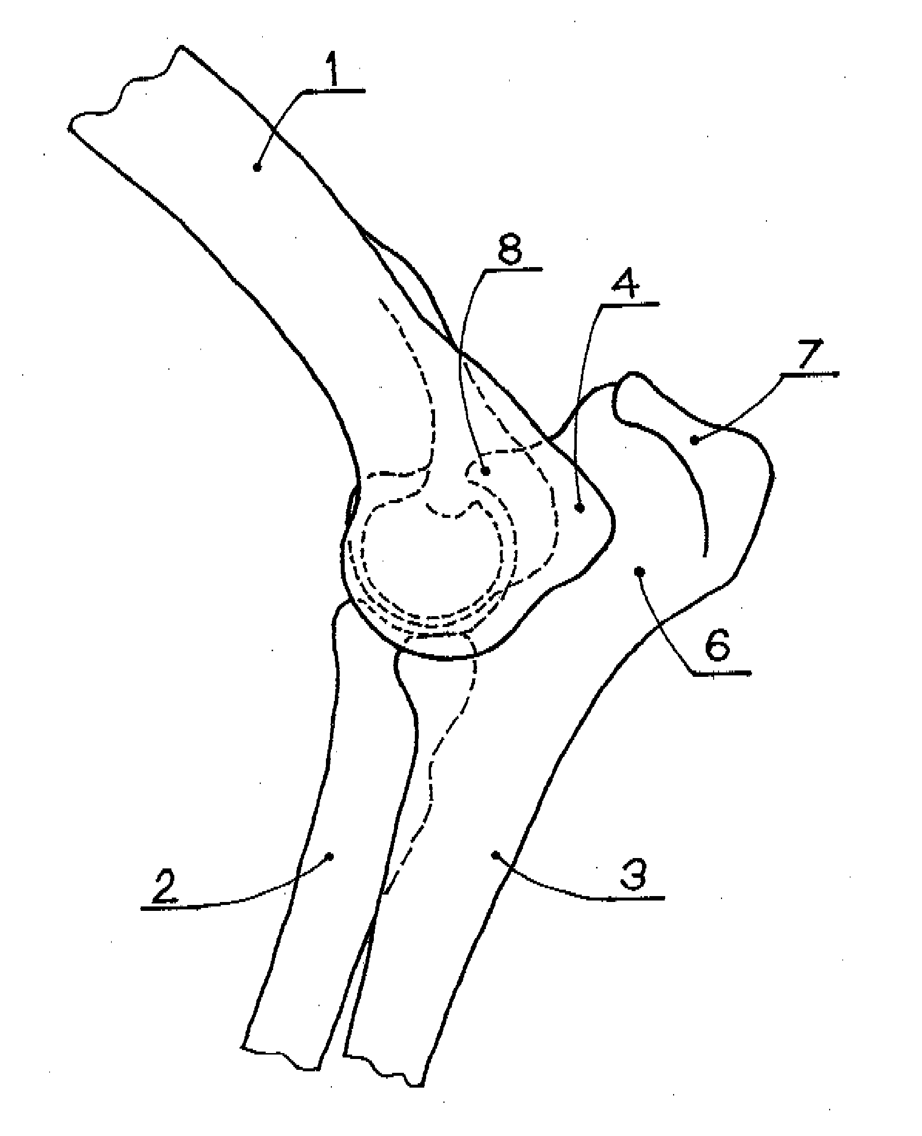 Elbow joint prosthesis and method for implantation