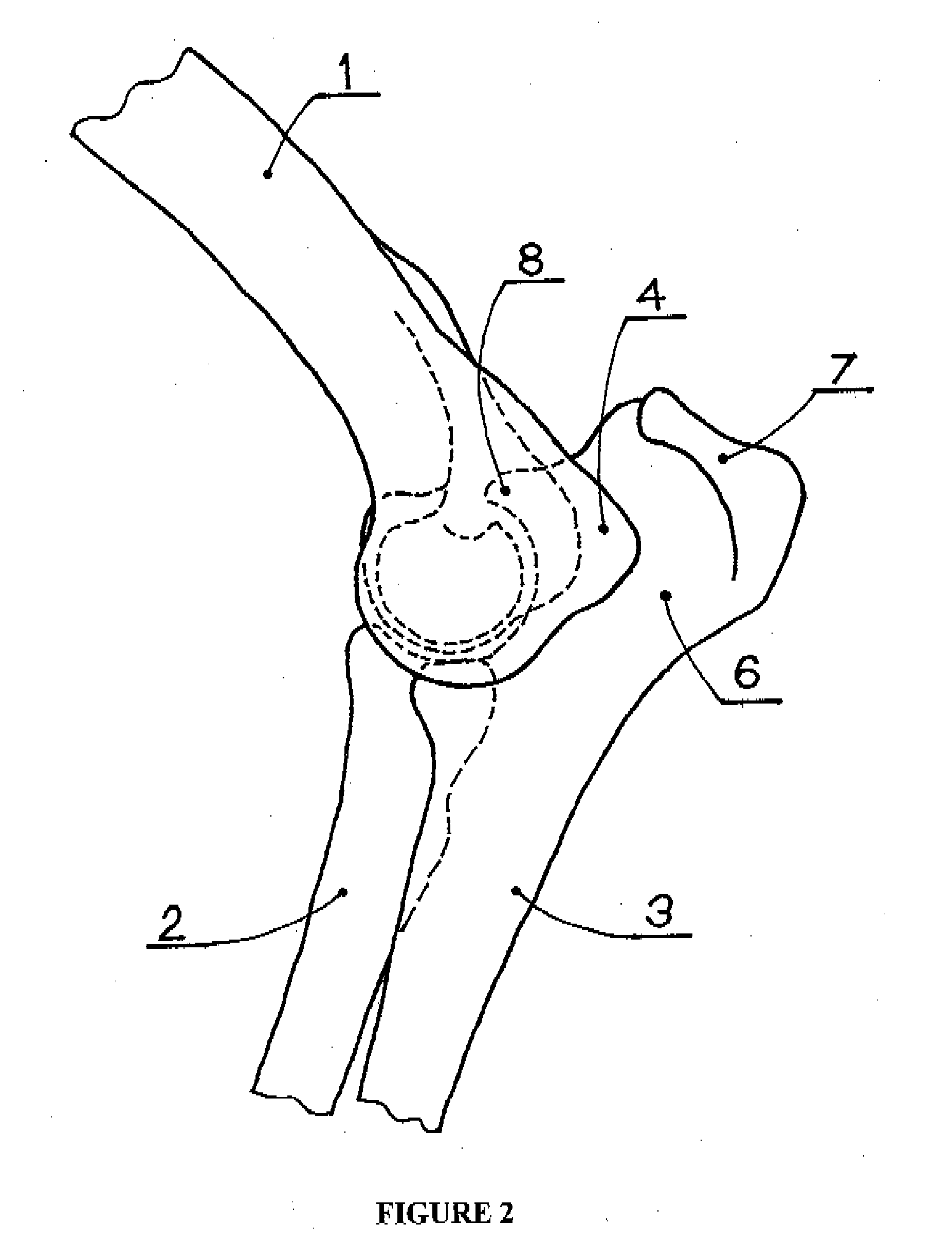 Elbow joint prosthesis and method for implantation