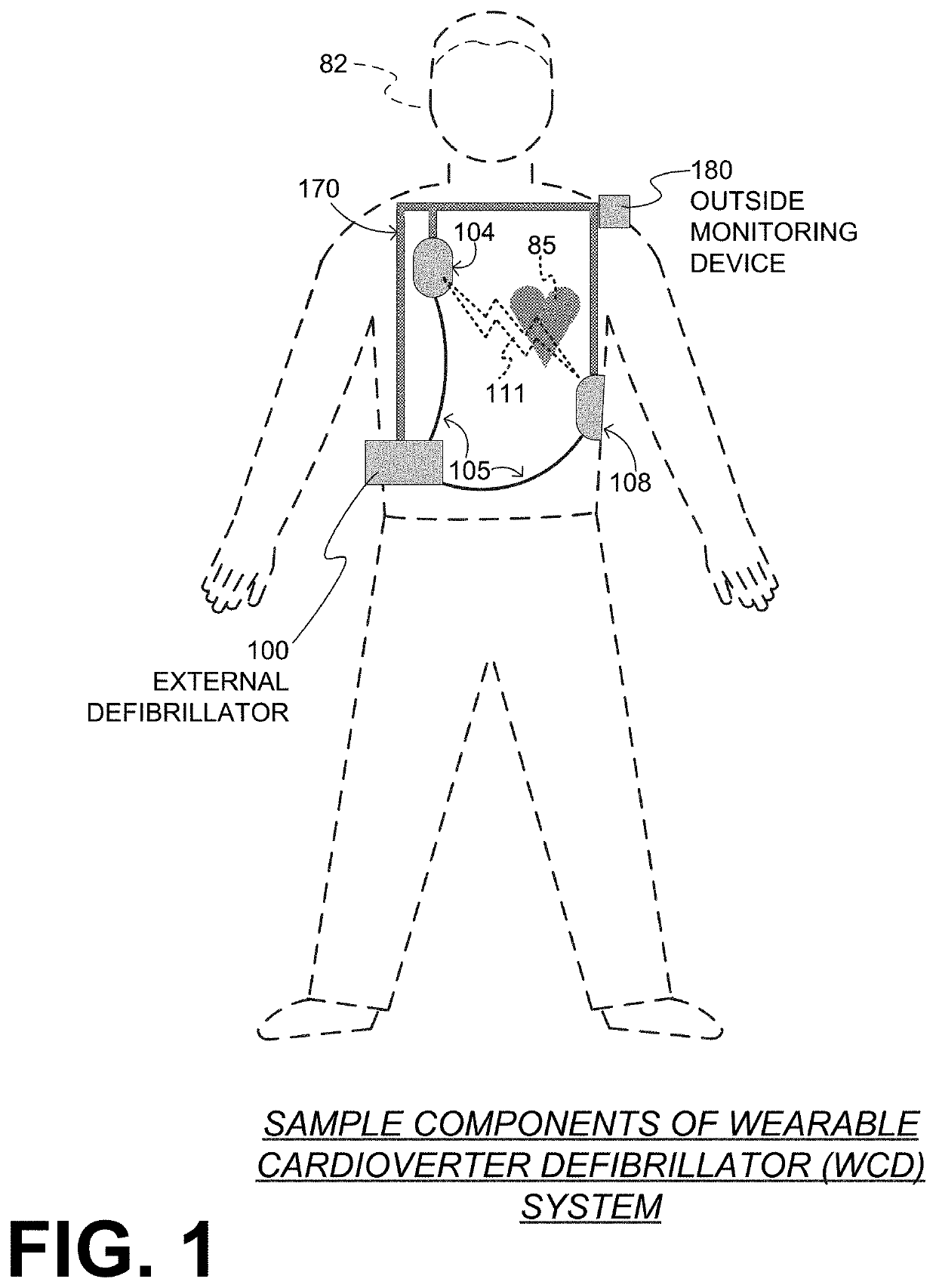 Wearable cardioverter defibrillator (WCD) system reacting to high-frequency ECG noise