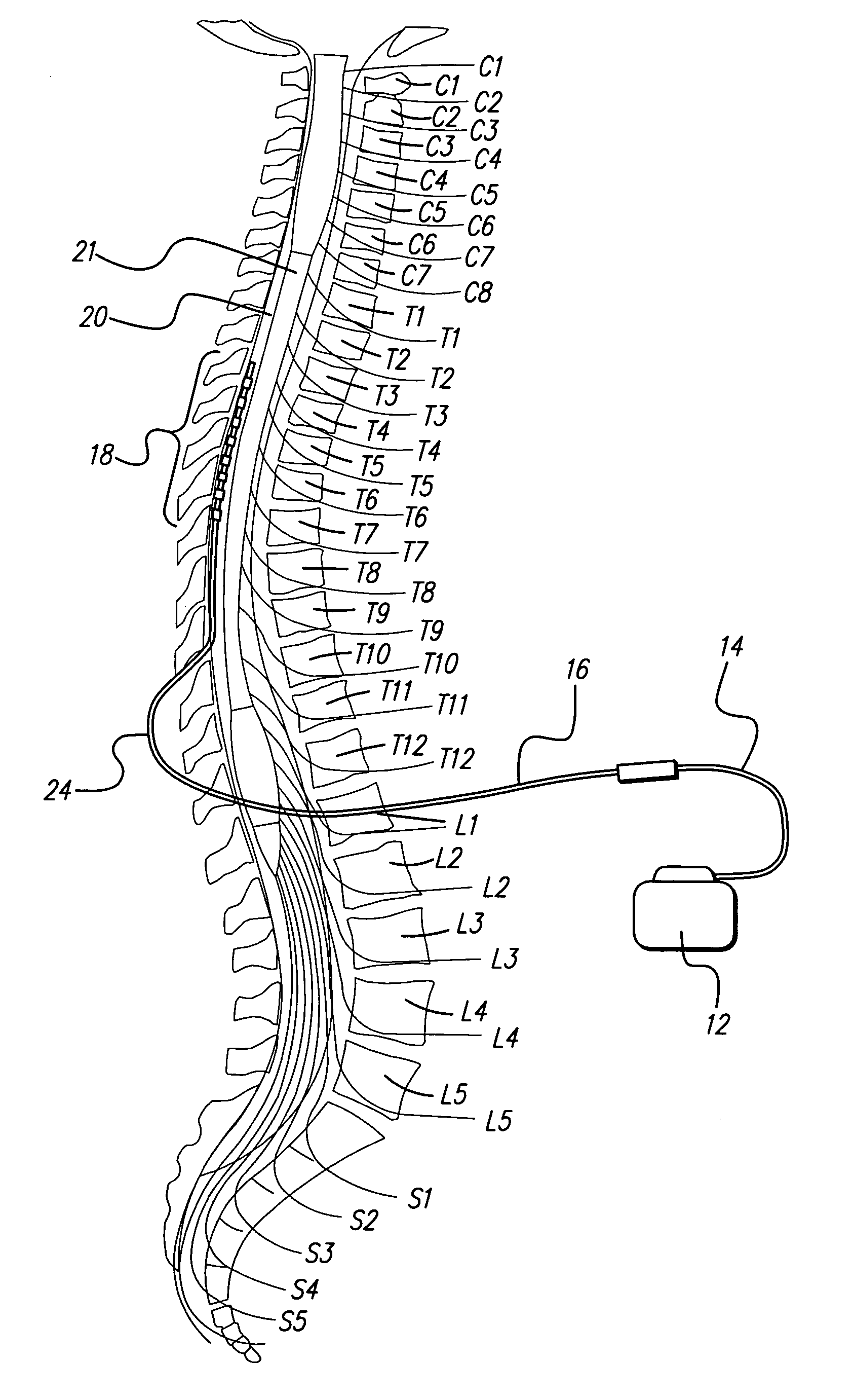 Method for optimizing search for spinal cord stimulation parameter settings