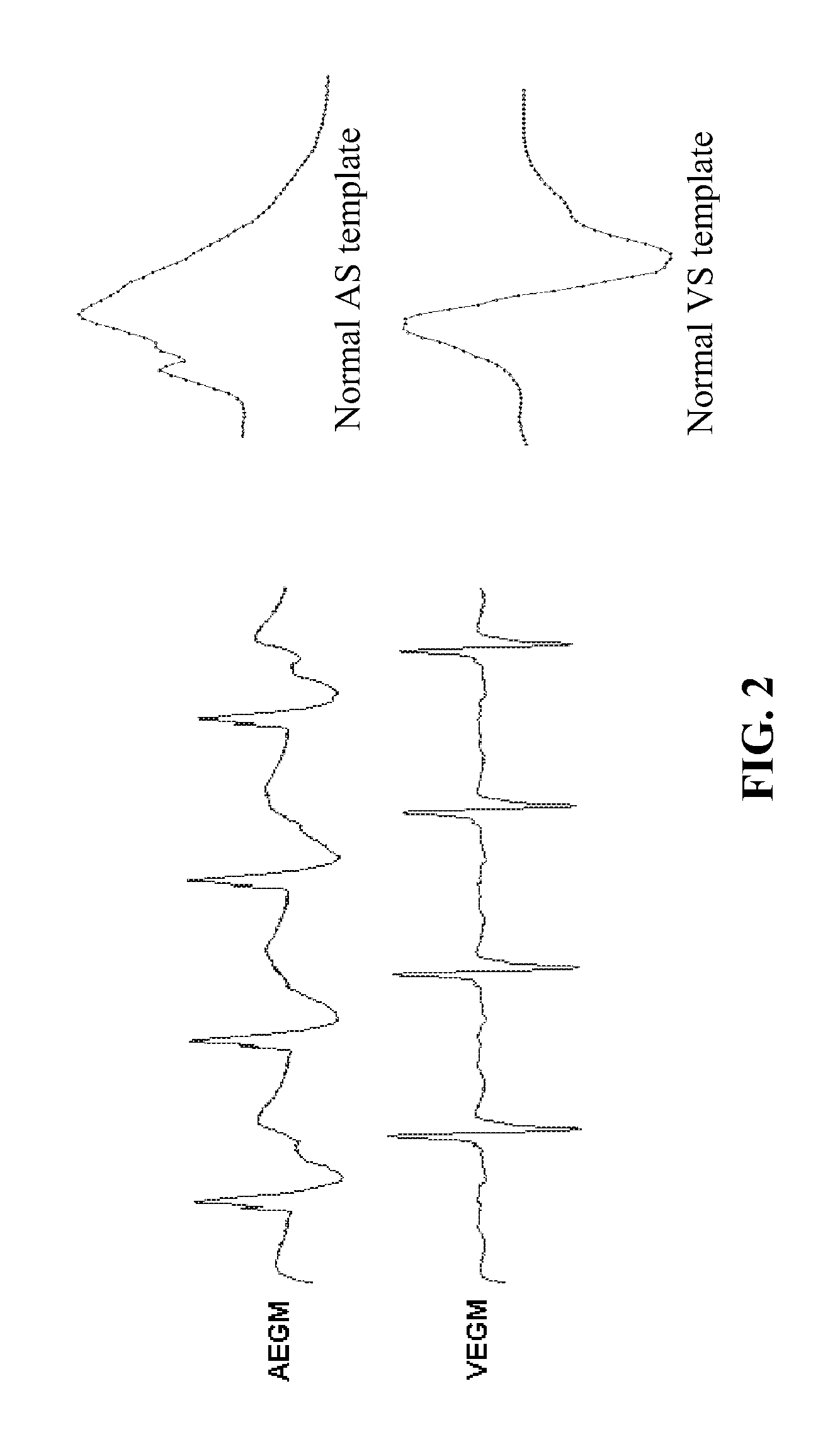 Device, method and computer-readable storage medium for enhanced sense event classification in implantable devices by means of morphology analysis