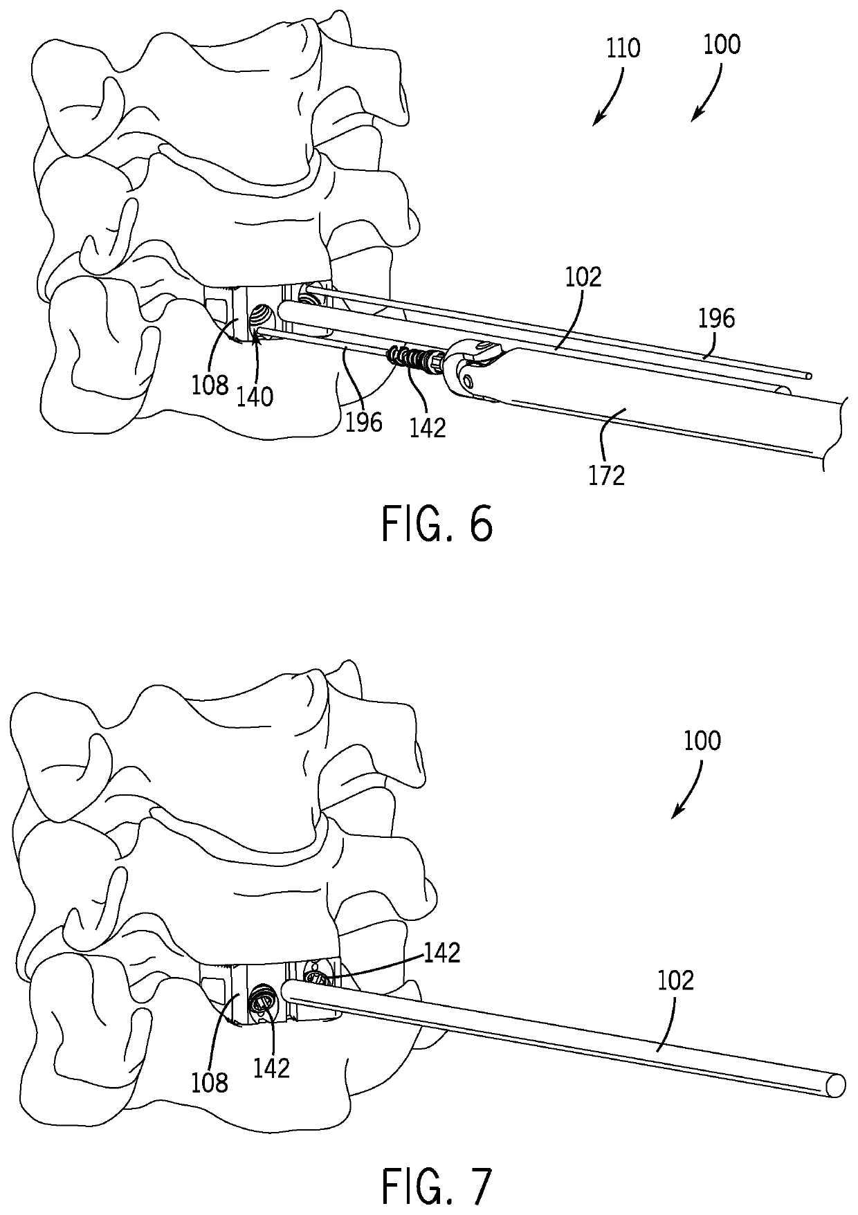 Spinal joint implant delivery device and system