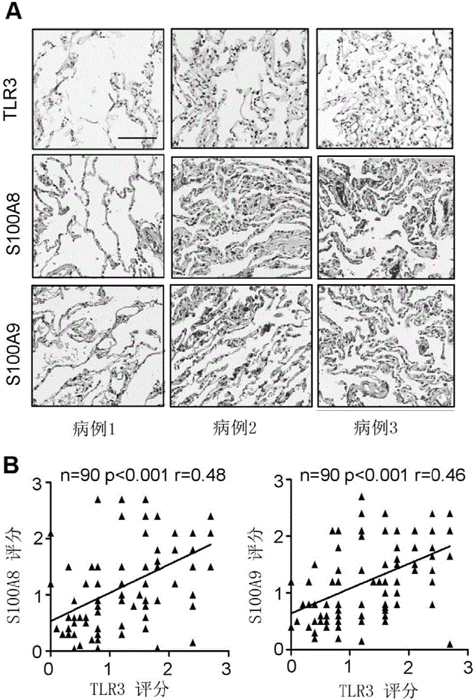 Application of TLR3 in predicting tumor transfer, evaluating prognosis and selecting prevention and treatment schemes