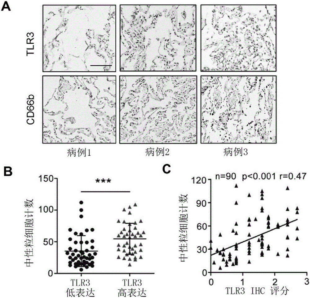 Application of TLR3 in predicting tumor transfer, evaluating prognosis and selecting prevention and treatment schemes