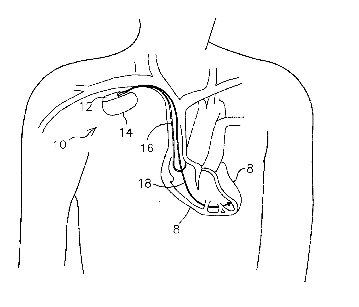 Methods for adjusting cardiac detection criteria and implantable medical devices using same