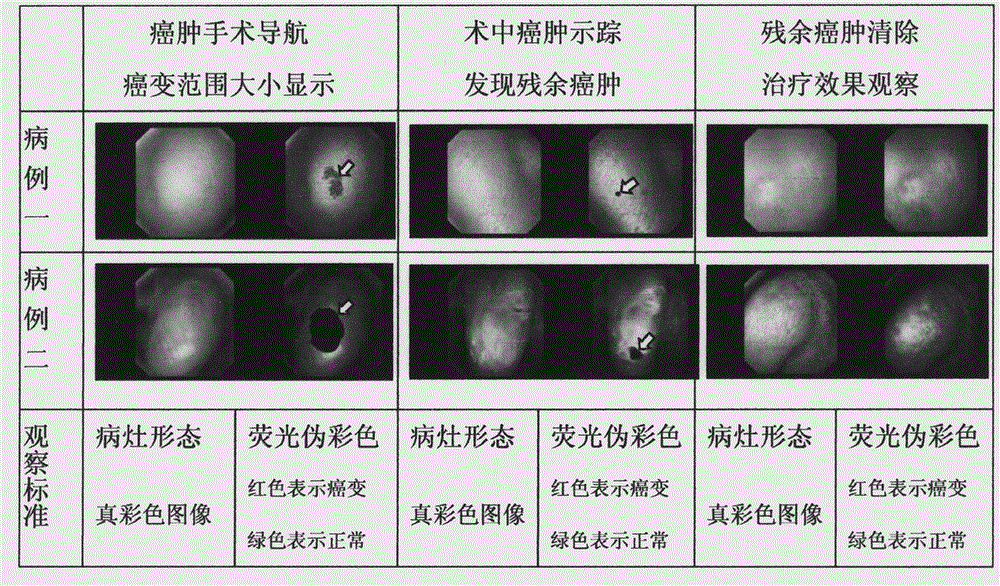 Device for cancer surgery fluorescence guiding and residual cancer tracing and clearing