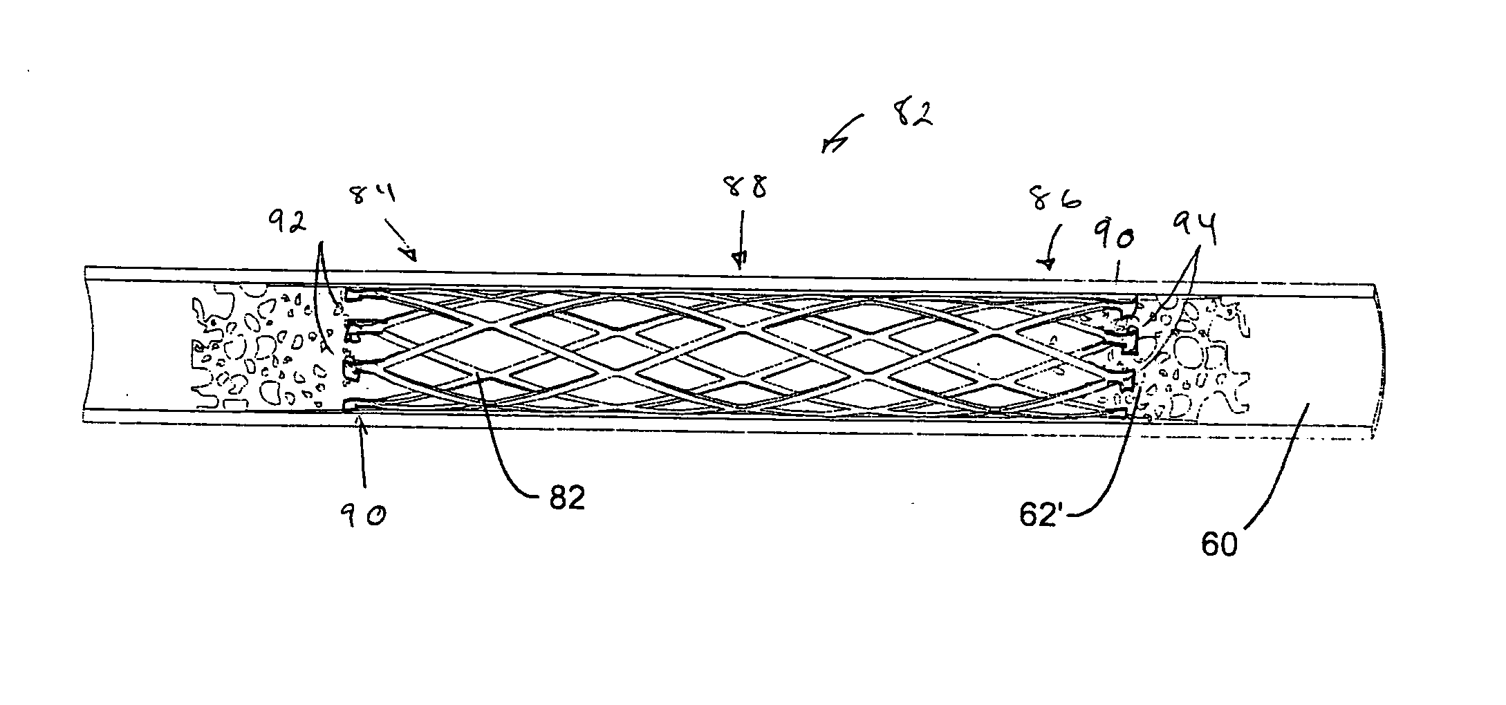 Tubular restraint release approaches for electrolytic implant delivery system