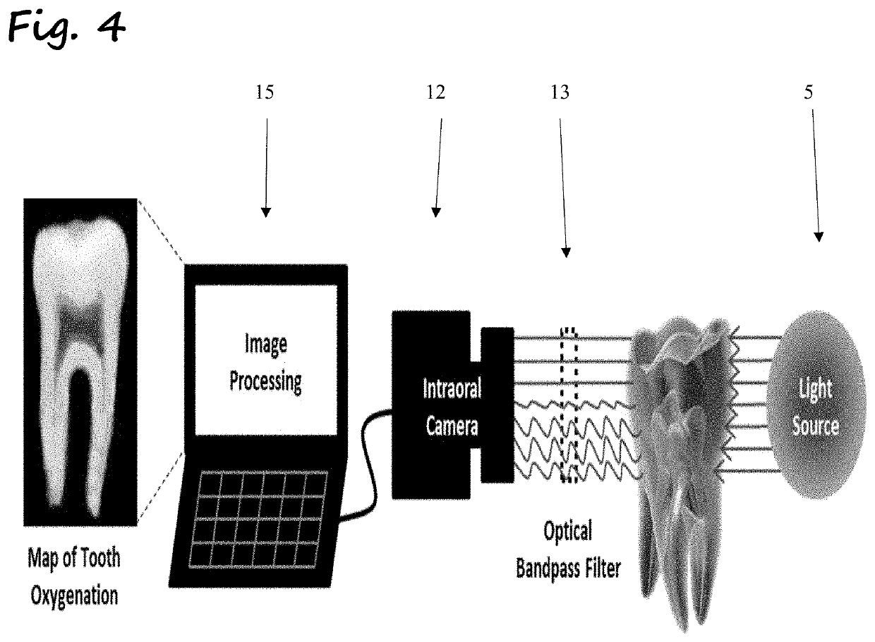 Photoplethysmography Imaging (PPGI)-Based Pulp Vitality Test