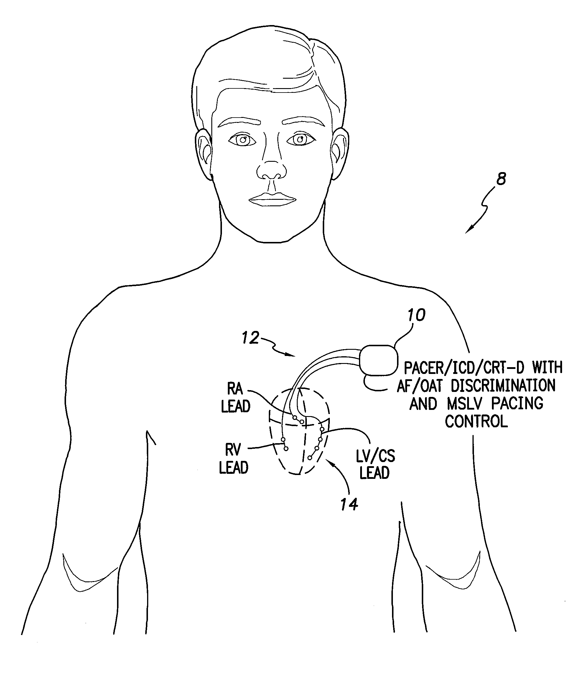 Systems and Methods for Use by an Implantable Medical Device for Controlling Multi-Site CRT Pacing in the Presence of Atrial Tachycardia