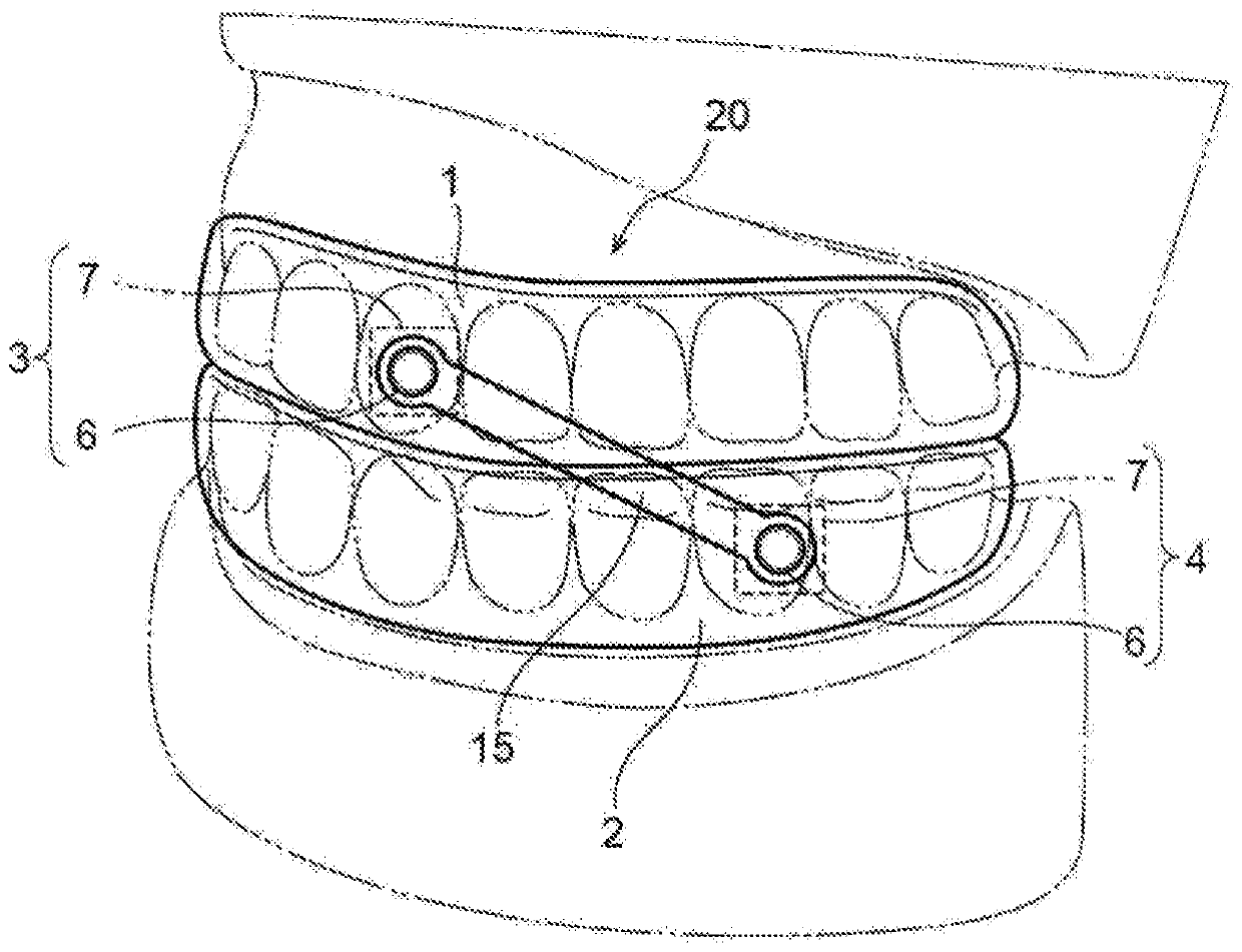 Mouthpiece