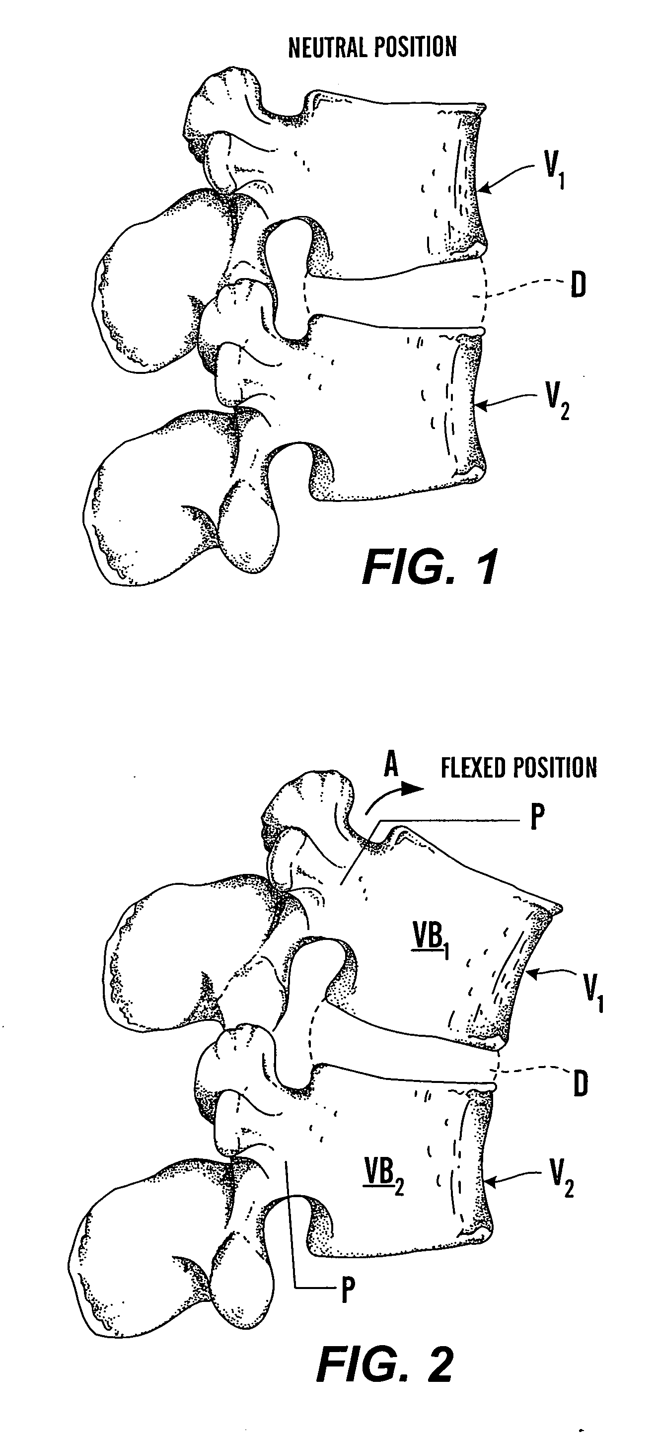 Dynamic fixation device and method of use