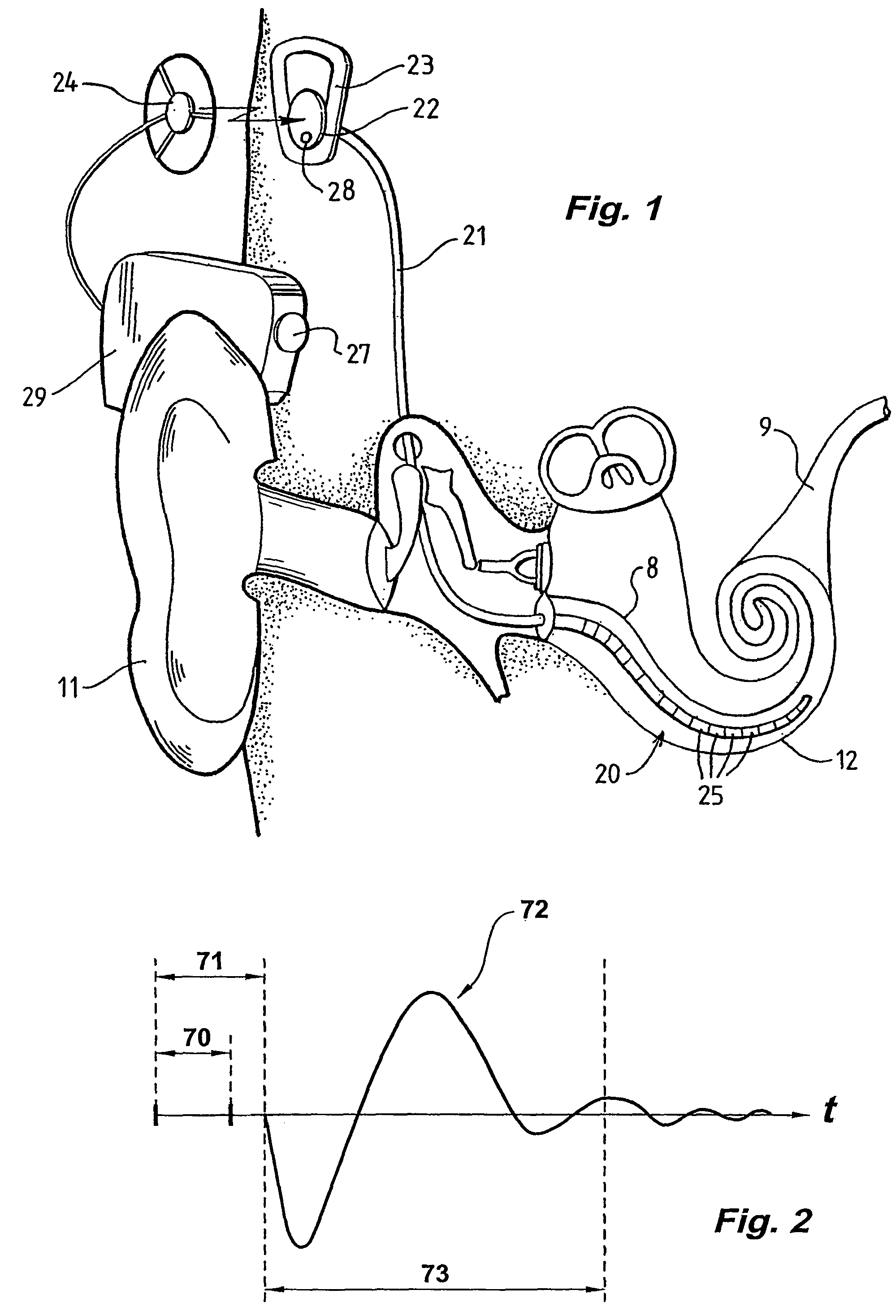 Measurement of evoked neural response