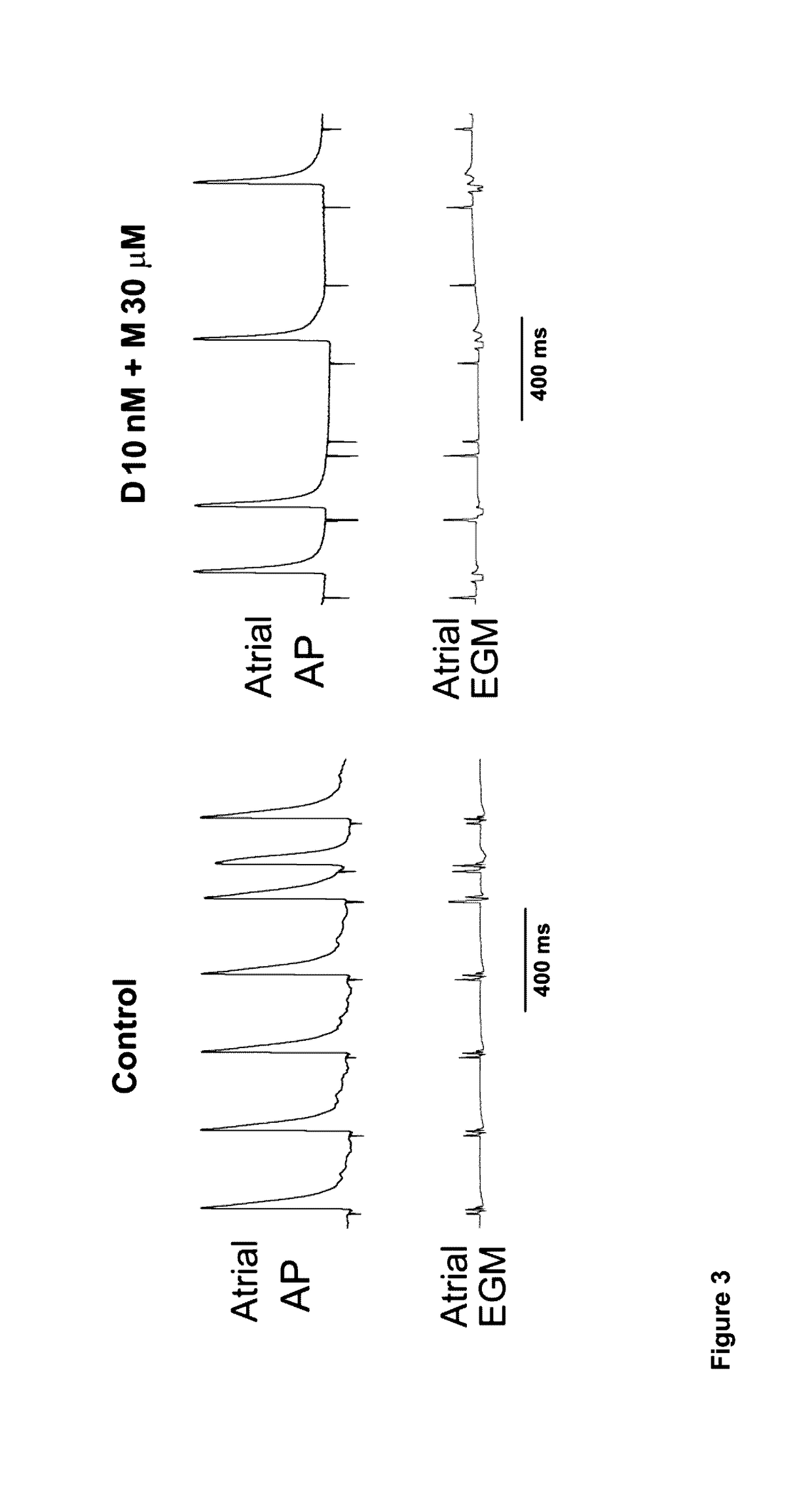 Combination of dofetilide and mexiletine for the prevention and treatment of atrial fibrillation